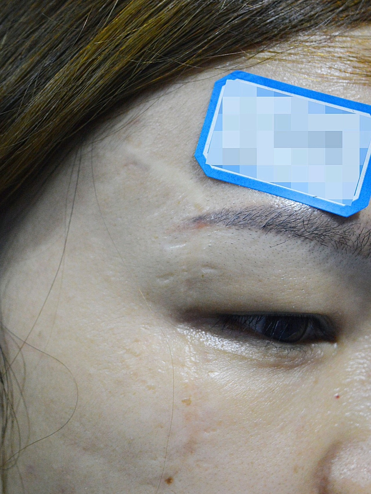 脸上的疤痕我之前是去植皮过的,但是效果不是很好,可_圈子-新氧美容