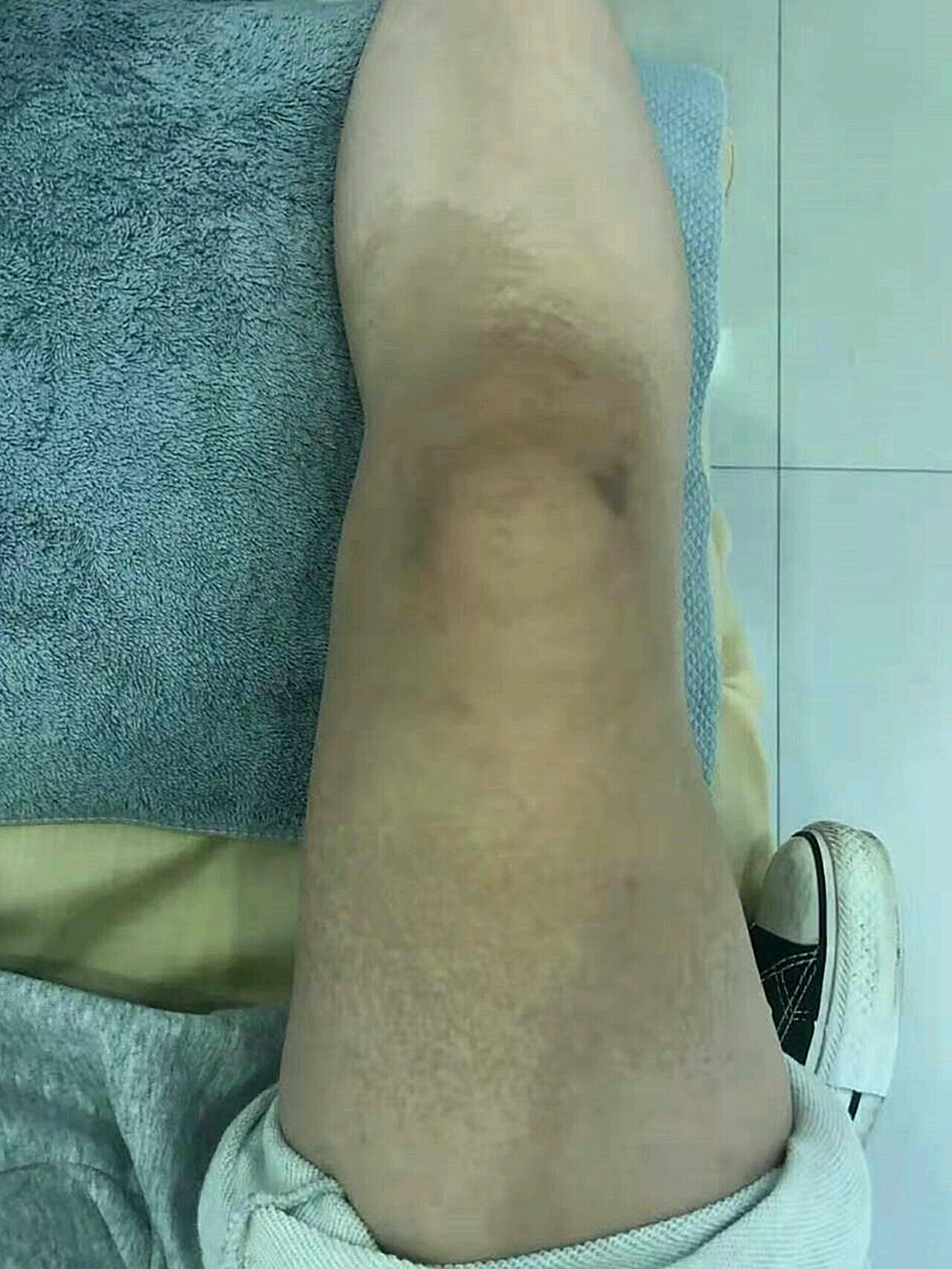 目前膝盖还有点黑,周边颜色淡了很多,几乎看不见了,_圈子-新氧美容