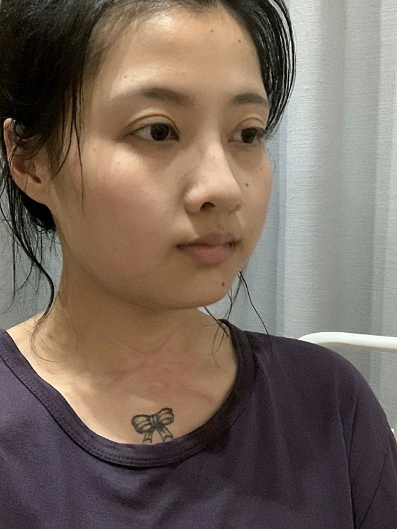 脖子烫伤疤痕激光祛疤治疗26天,今天来给大家分享一_圈子-新氧美容