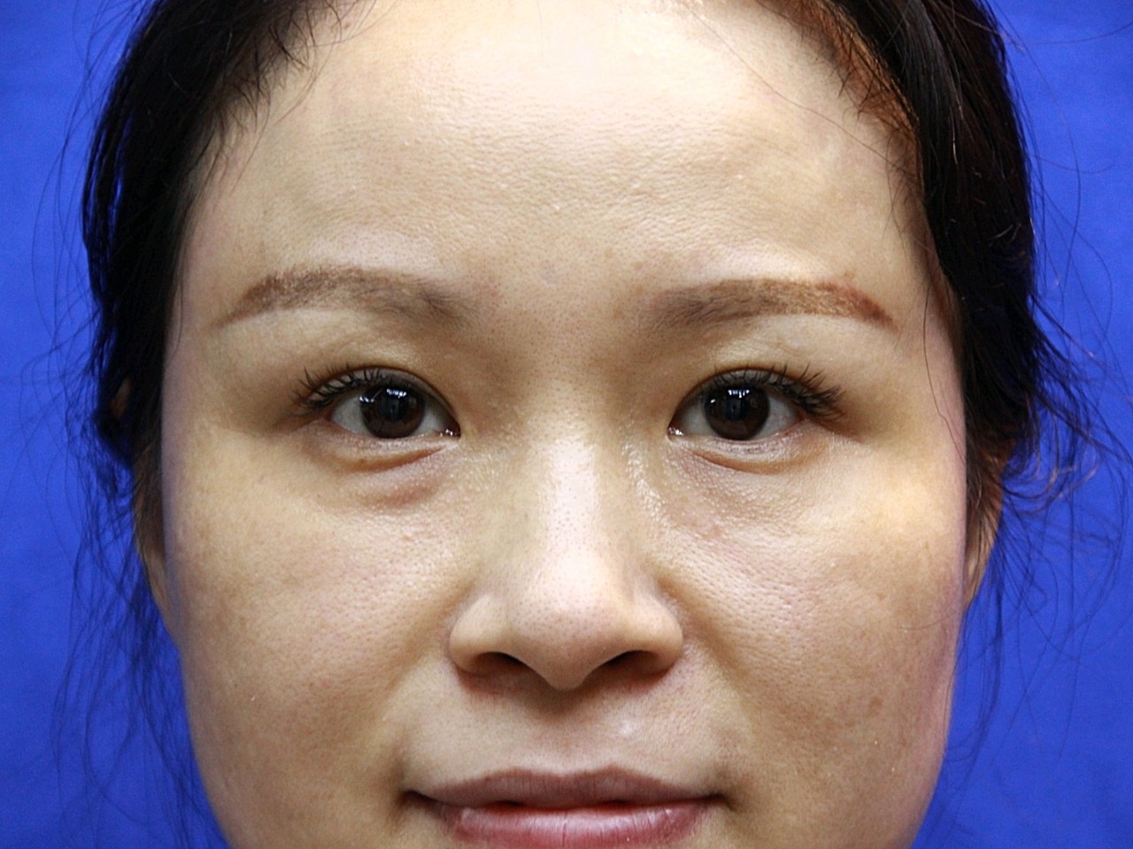 一点点的黑眼圈 一点眼袋 一点泪沟 一点皮肤下垂 一些干纹细纹