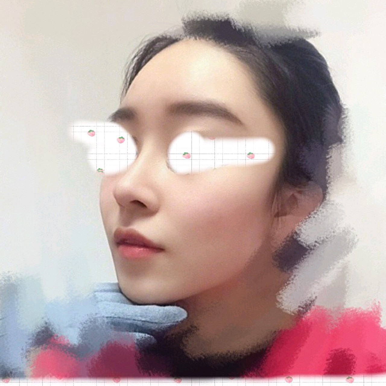 术前正侧面鼻梁短,山根低平,鼻头圆肉,侧面看视觉更_圈子-新氧美容