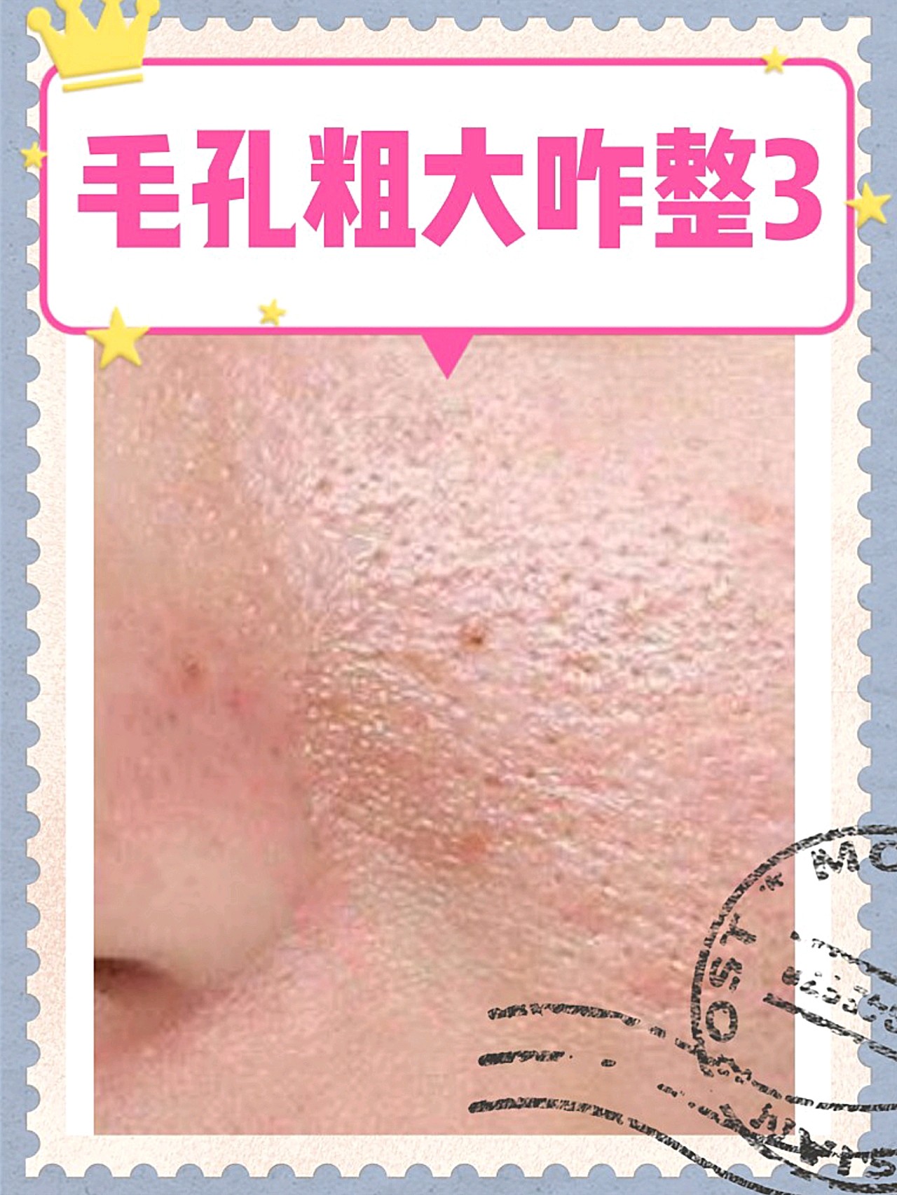 腿上鸡皮肤果酸换肤(果酸去鸡皮肤有效果吗)