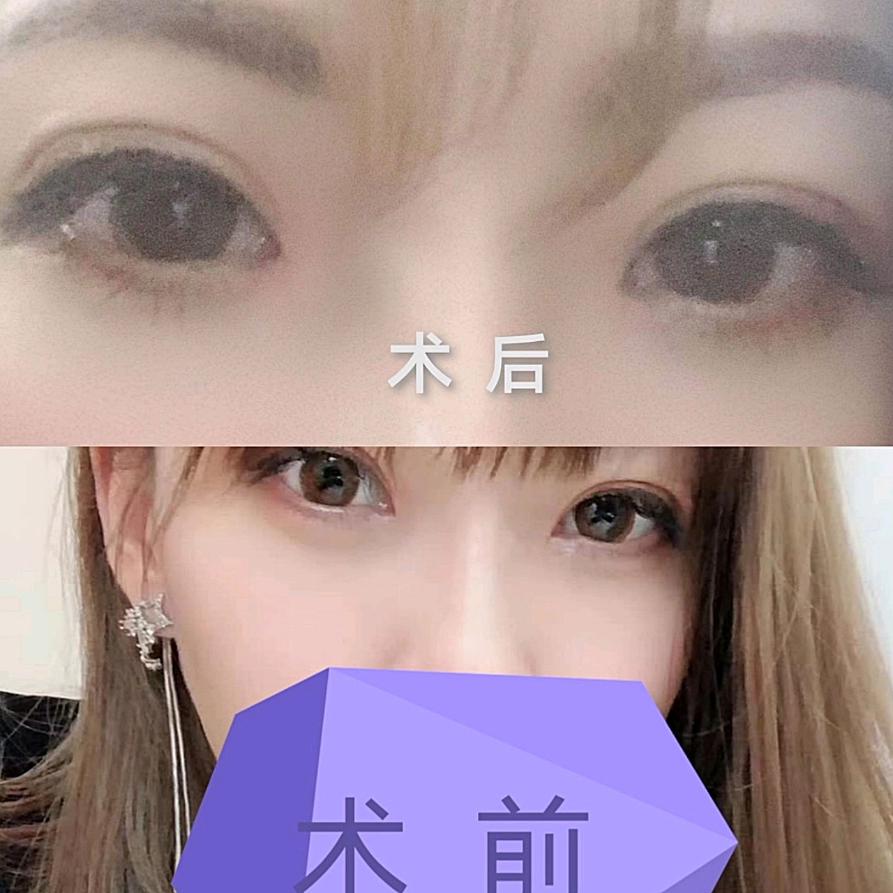 内眼角回包一个半月了,感觉恢复的太好啦.