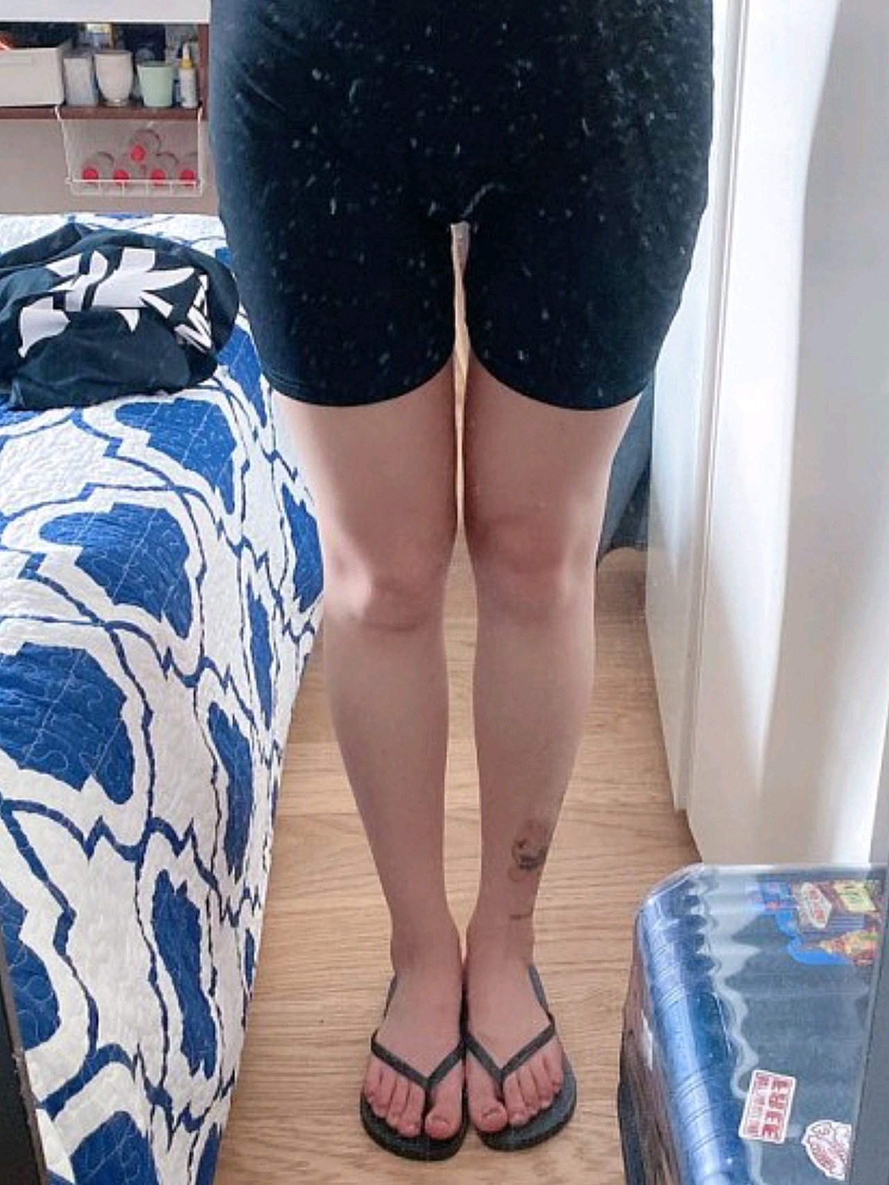 这是我大腿吸脂的术前术后对比,大家觉得咋样?