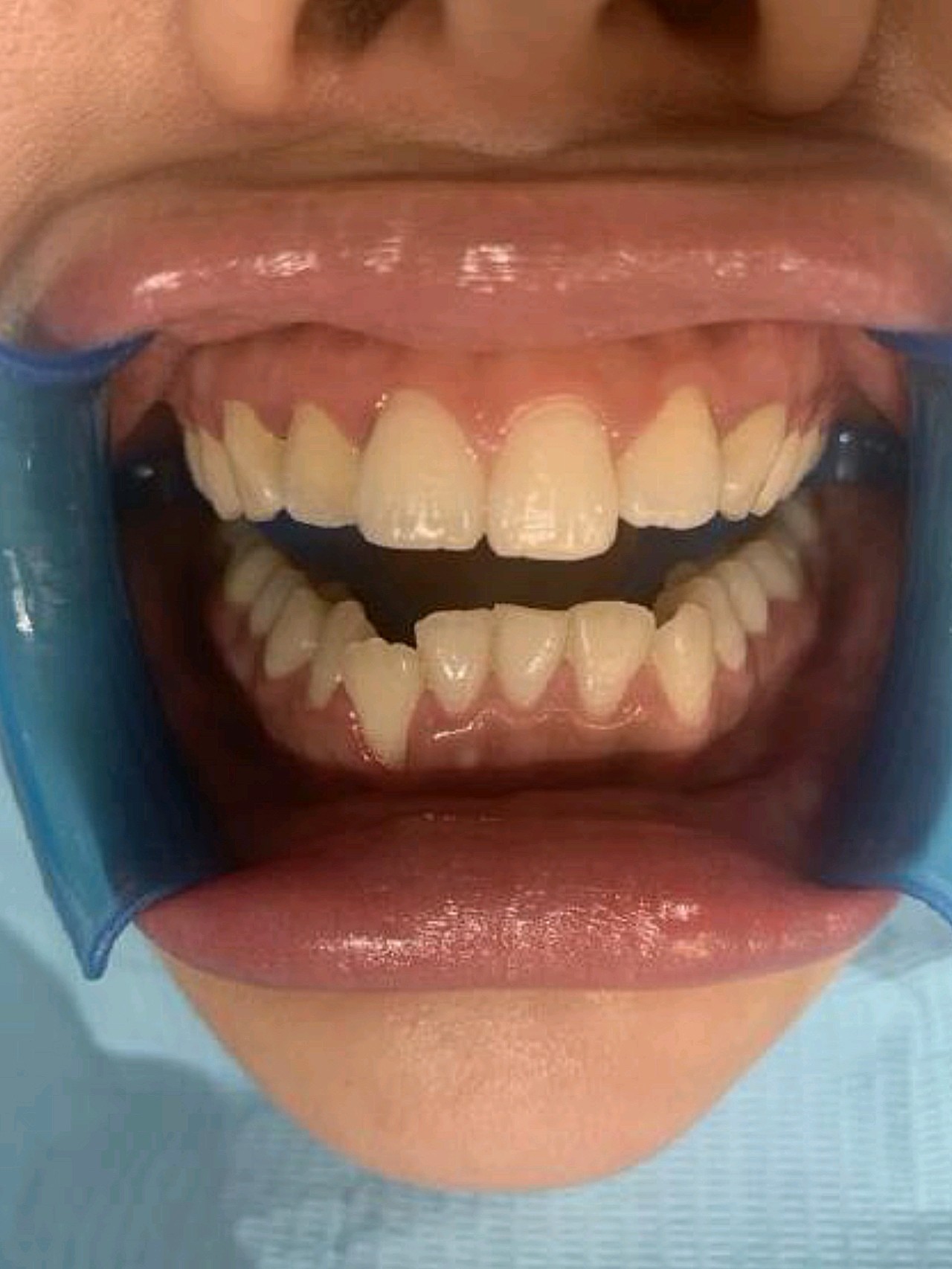 从小因为水质的原因牙很黄,真的丑死了,最近才知道有_圈子-新氧美容