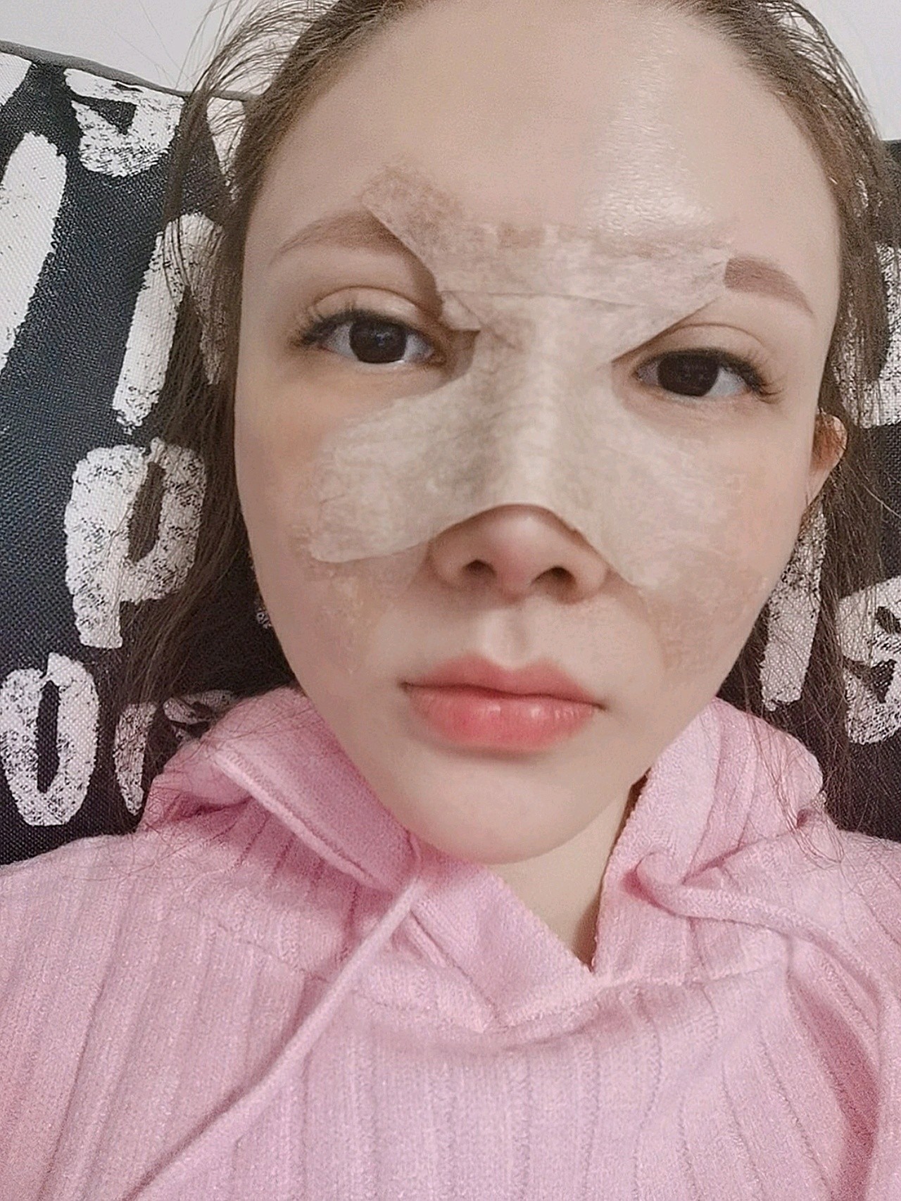 【硅胶隆鼻术后第三天】
