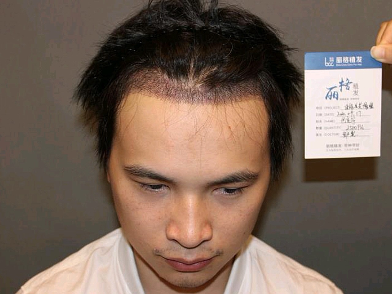 发际线脱发变秃怎么办?拯救脱发方法来了!