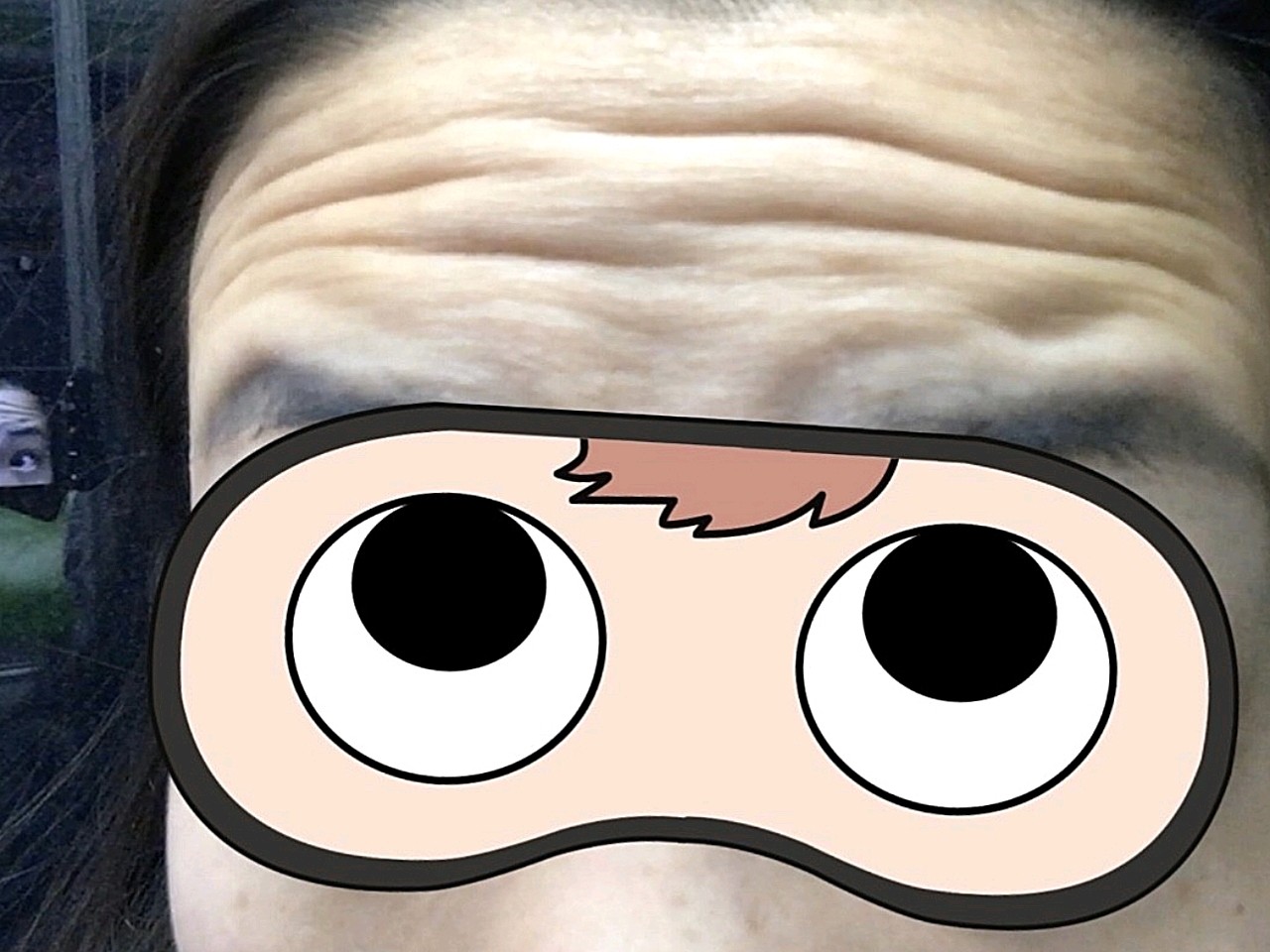 之前我的抬头纹特别严重,在德玛家做的去皱效果很明显_圈子-新氧美容