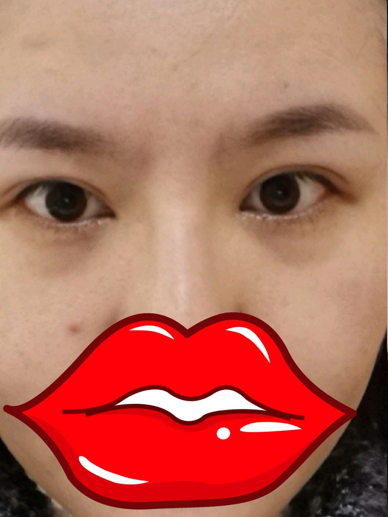 眼部有轻微的眼袋,没必要做切除手术,来是试一下时下_圈子-新氧美容