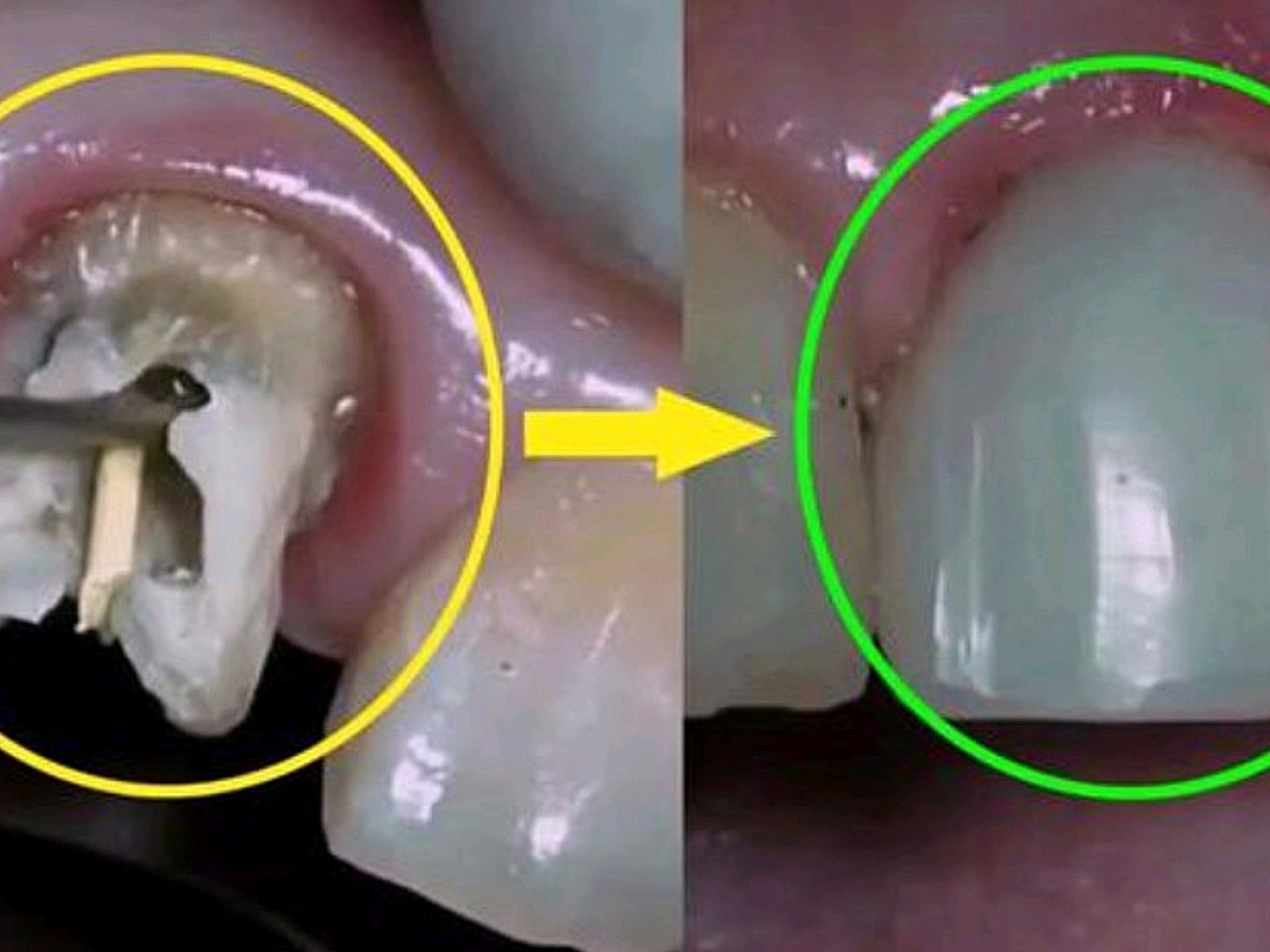 1,根管治疗是以药物以及器械的操作来将根管内的残渣_圈子-新氧美容