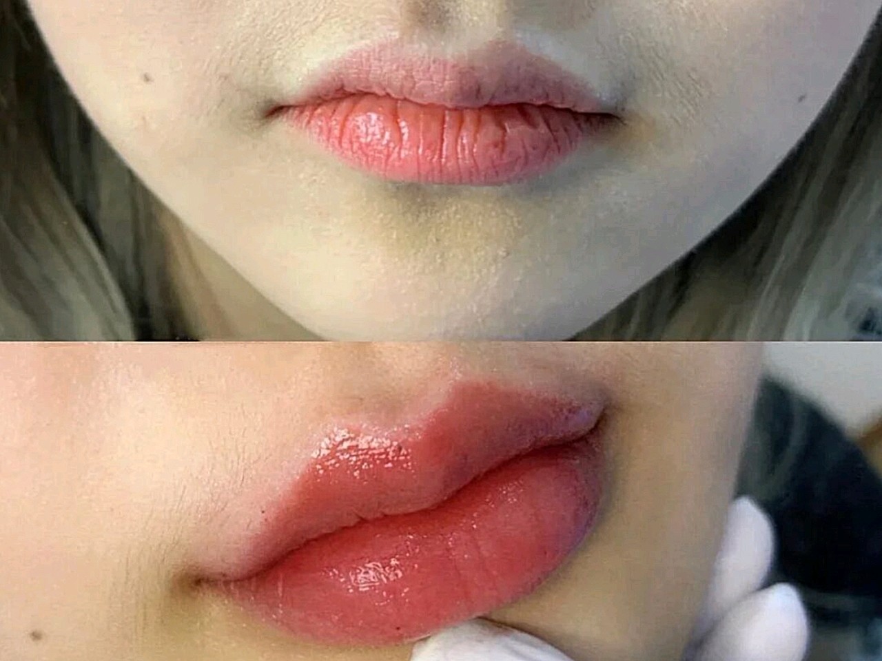 微微调整了下唇部,打的瑞蓝玻尿酸唇峰,下唇还有唇线_圈子-新氧美容
