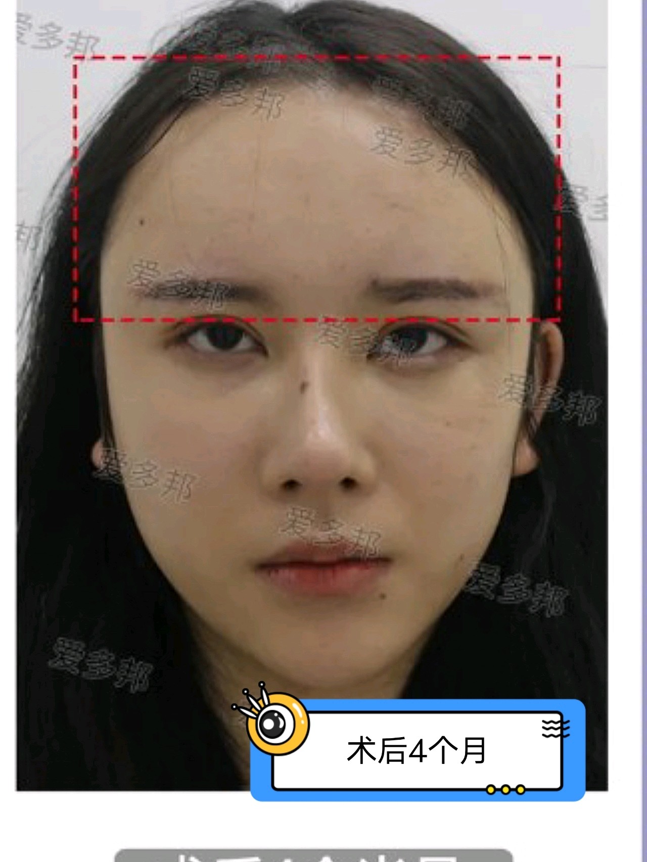 额头生长因子取出术后10个月分享
