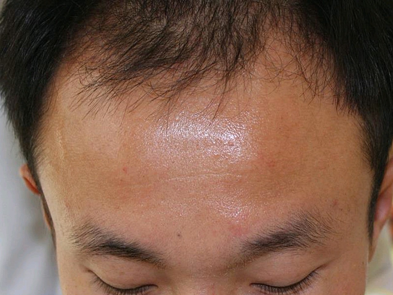 程序员的悲哀头顶和发际线越来越稀疏