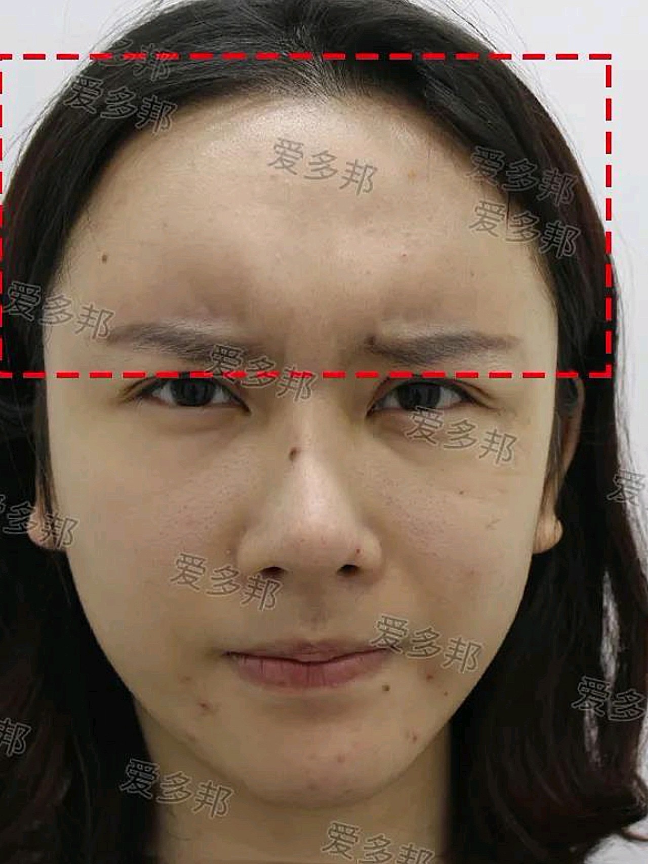 额头生长因子取出术后10个月分享