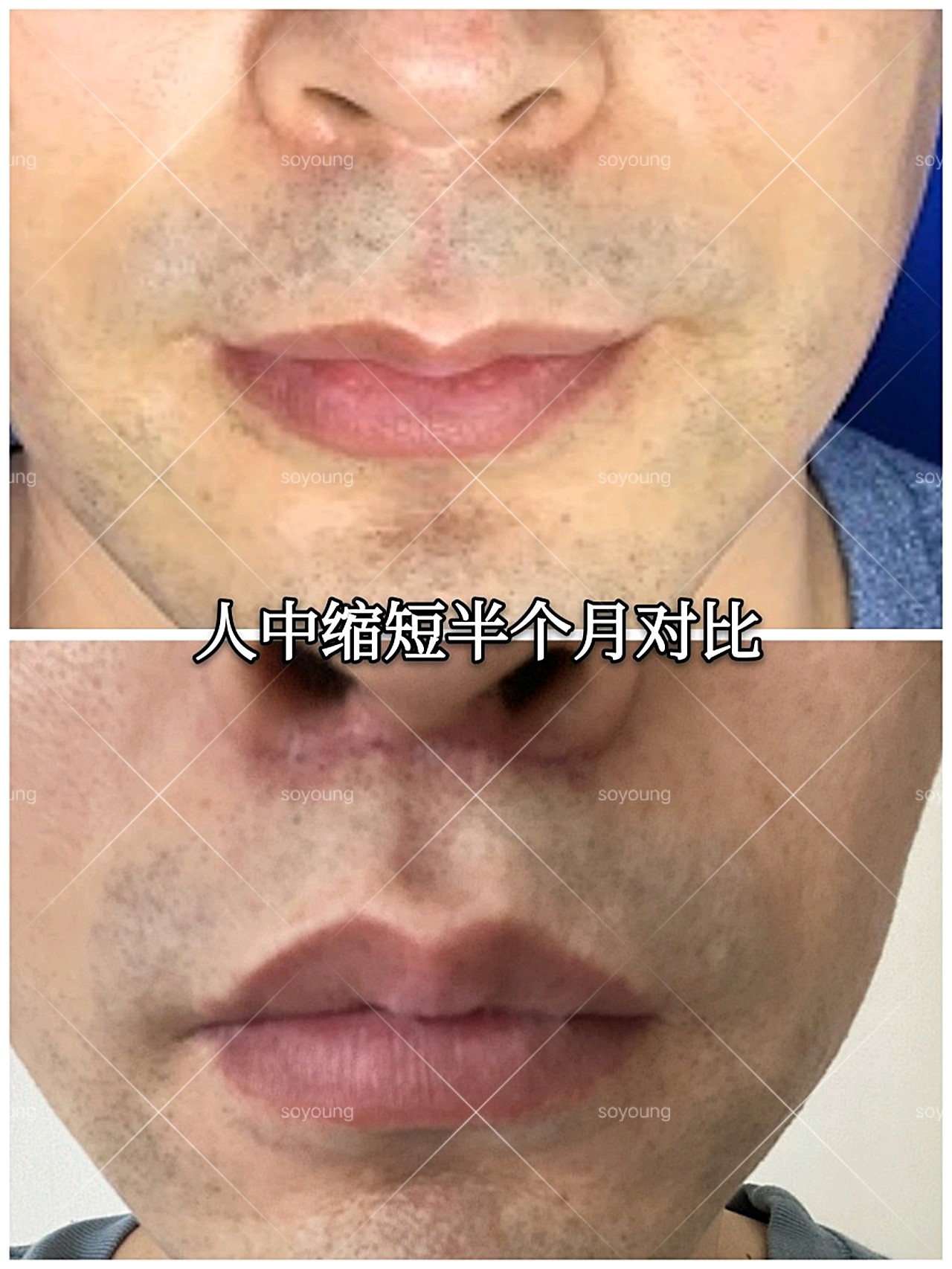 男人人中太长脸型难看怎么破?