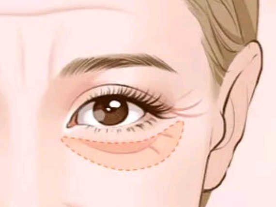 外切法祛眼袋切口在下眼皮睫毛下约2毫米处的皮肤上,_圈子-新氧美容