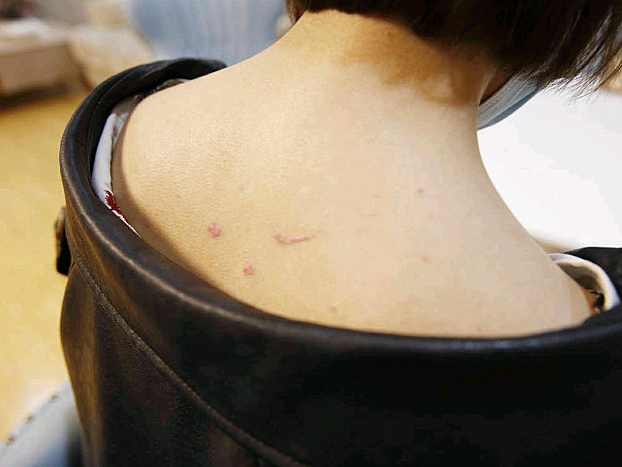 【激光祛疤46天】背上的疤痕疙瘩治疗有一段时间了