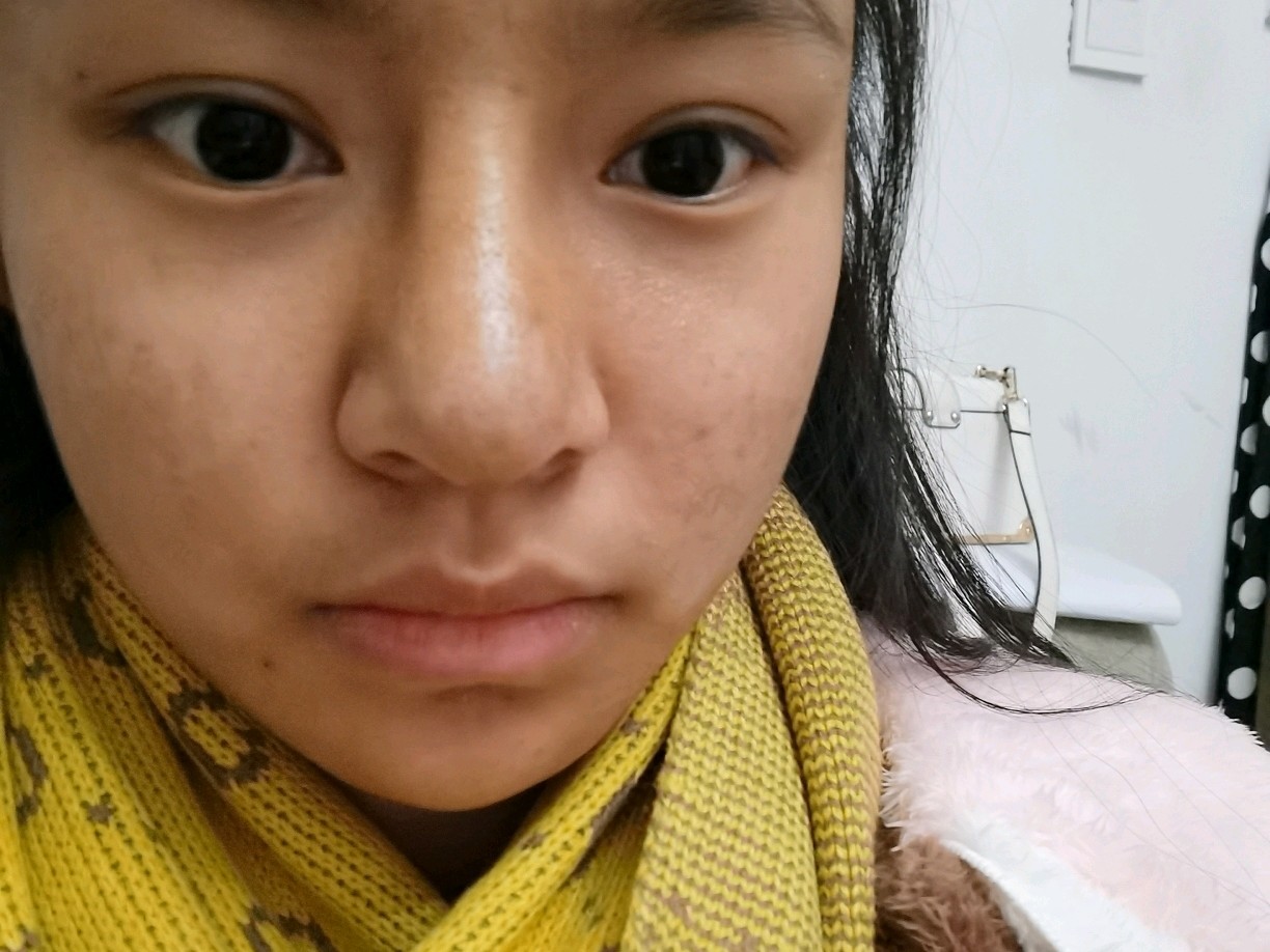 全肋骨隆鼻,感觉鼻背很宽粗后期会消肿吗求解答