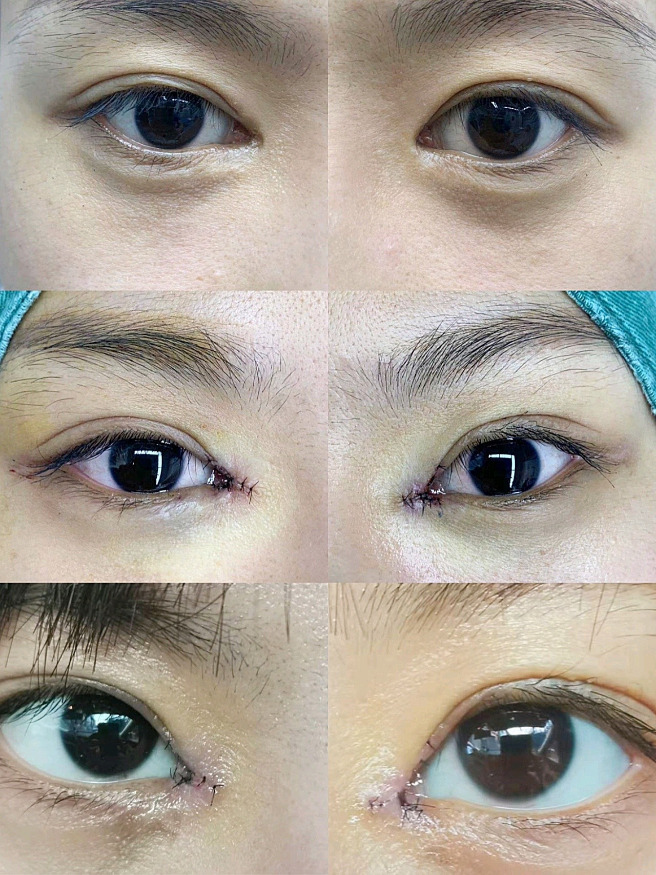 图片是术前,即刻,第五天的,做完回包,眼睛感觉圆了_圈子-新氧美容整形