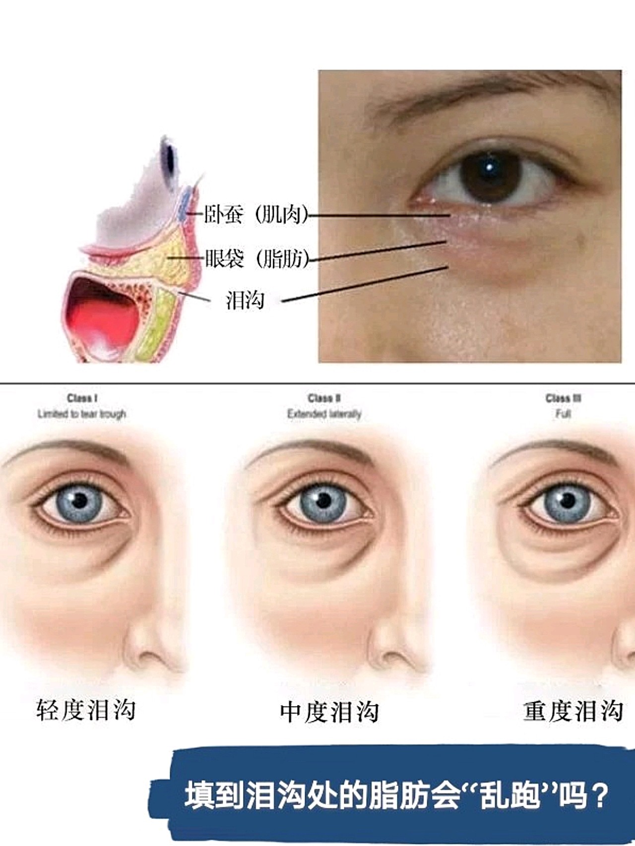 眼沟位置图片图片