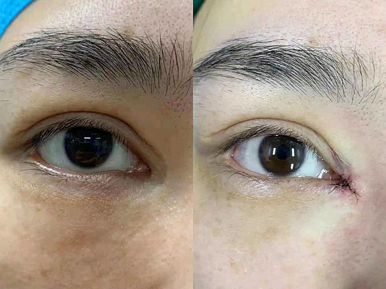 我是审美改变了才做的内眼角回包,我是别的平台刷到曾_圈子-新氧美容