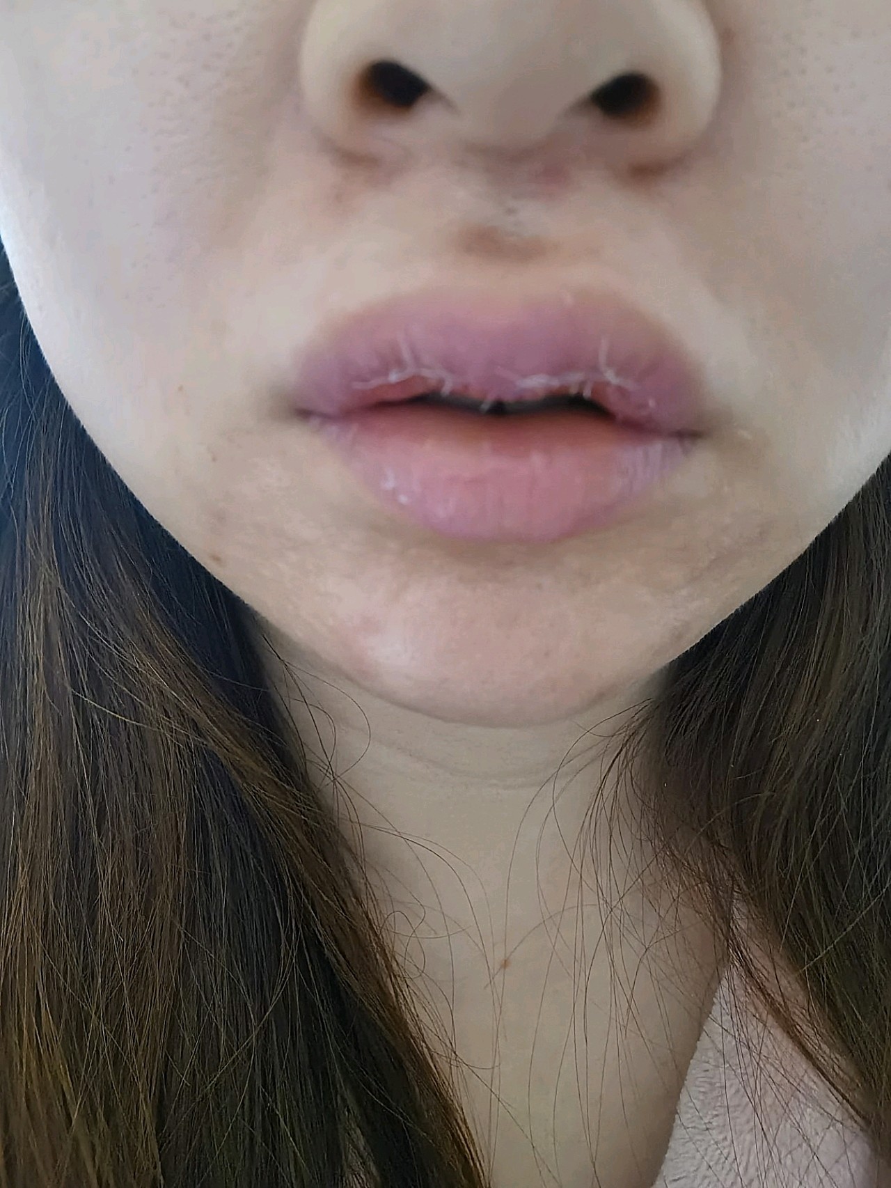 术后第二天,上唇简直肿成欧阳锋,从来没有这么肿过,_圈子-新氧美容