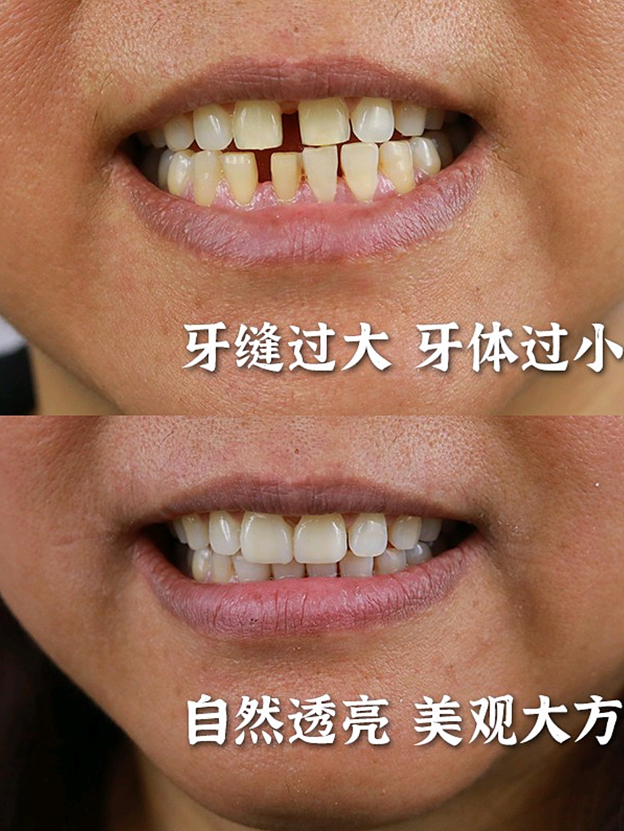 今日分享案例是,一位上牙齿缝隙过大,牙齿偏大的女士
