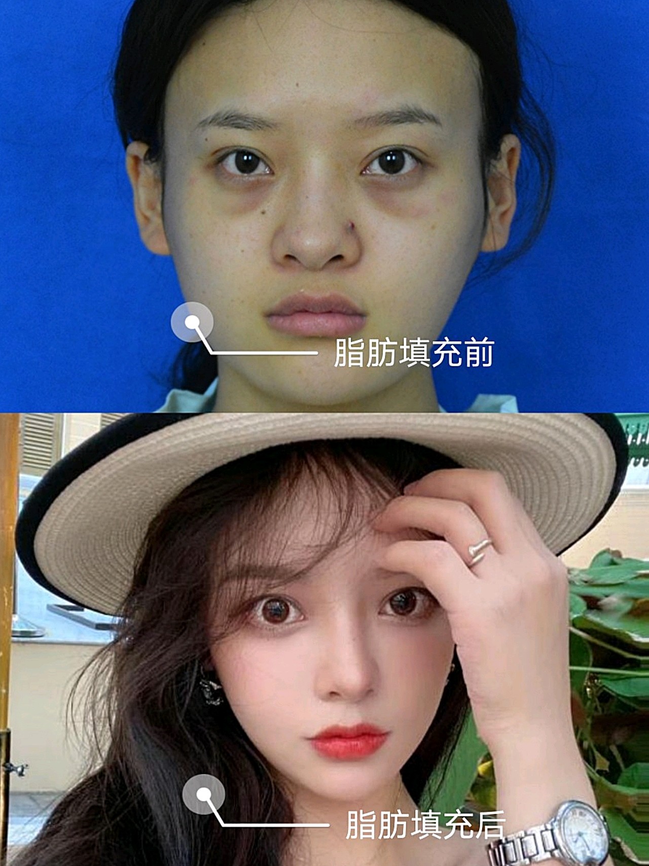 【术前诊断】:太阳穴/面颊凹陷,泪沟,苹果肌扁平,_圈子-新氧美容整形