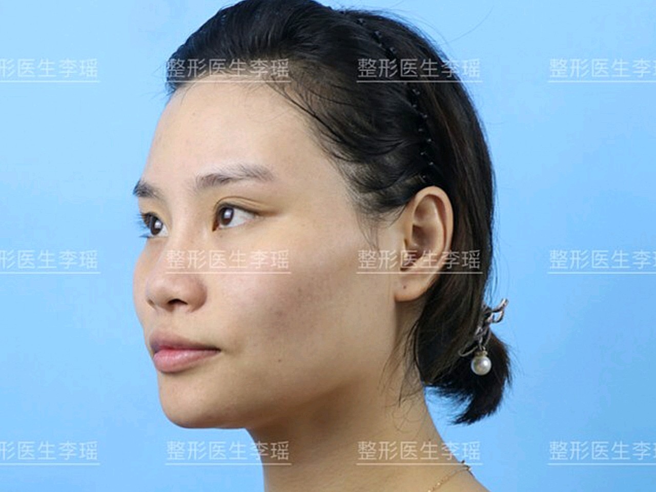 全脸面部填充对于颧骨凸起,太阳穴凹陷,下颌角宽大_圈子-新氧美容