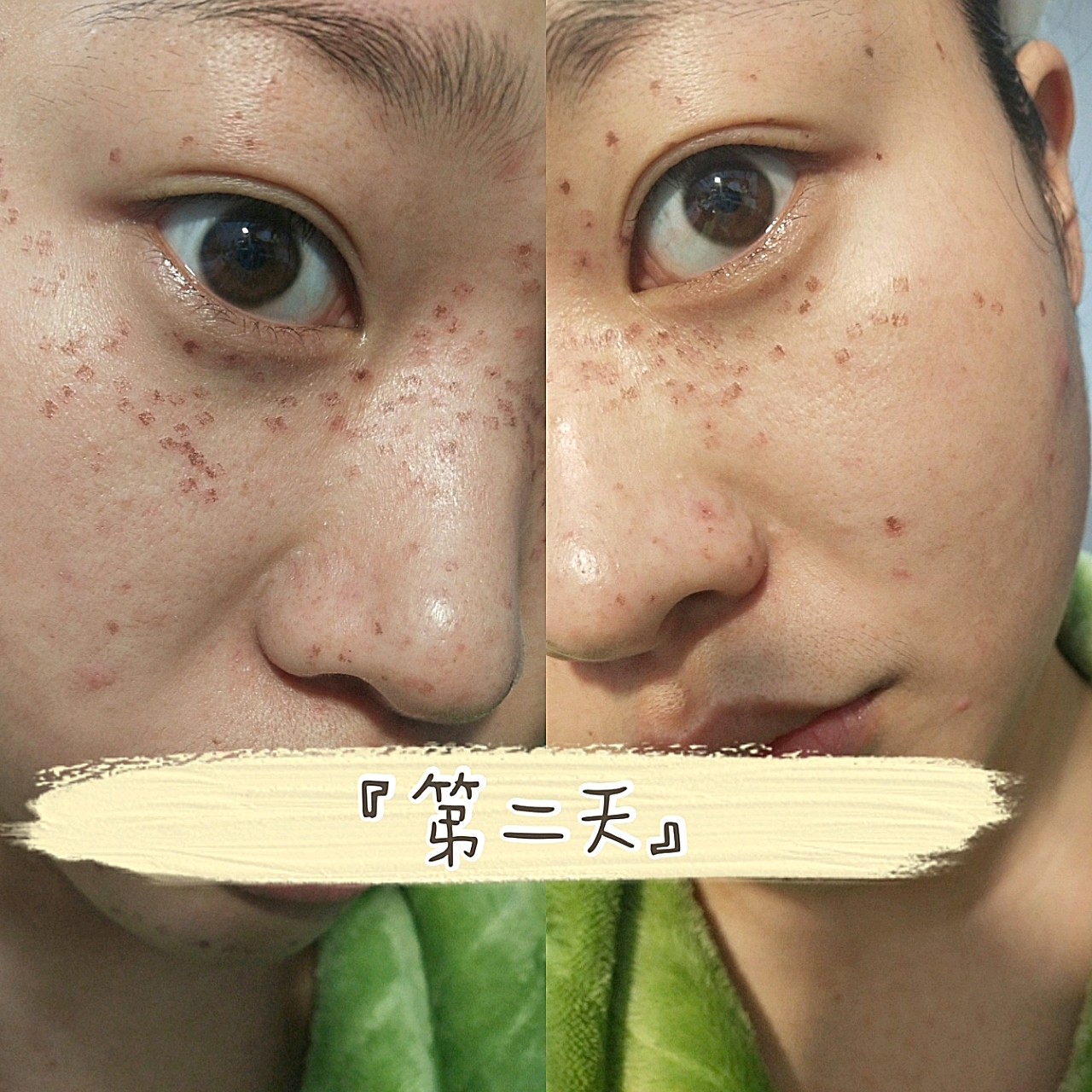 蜂巢皮秒祛斑