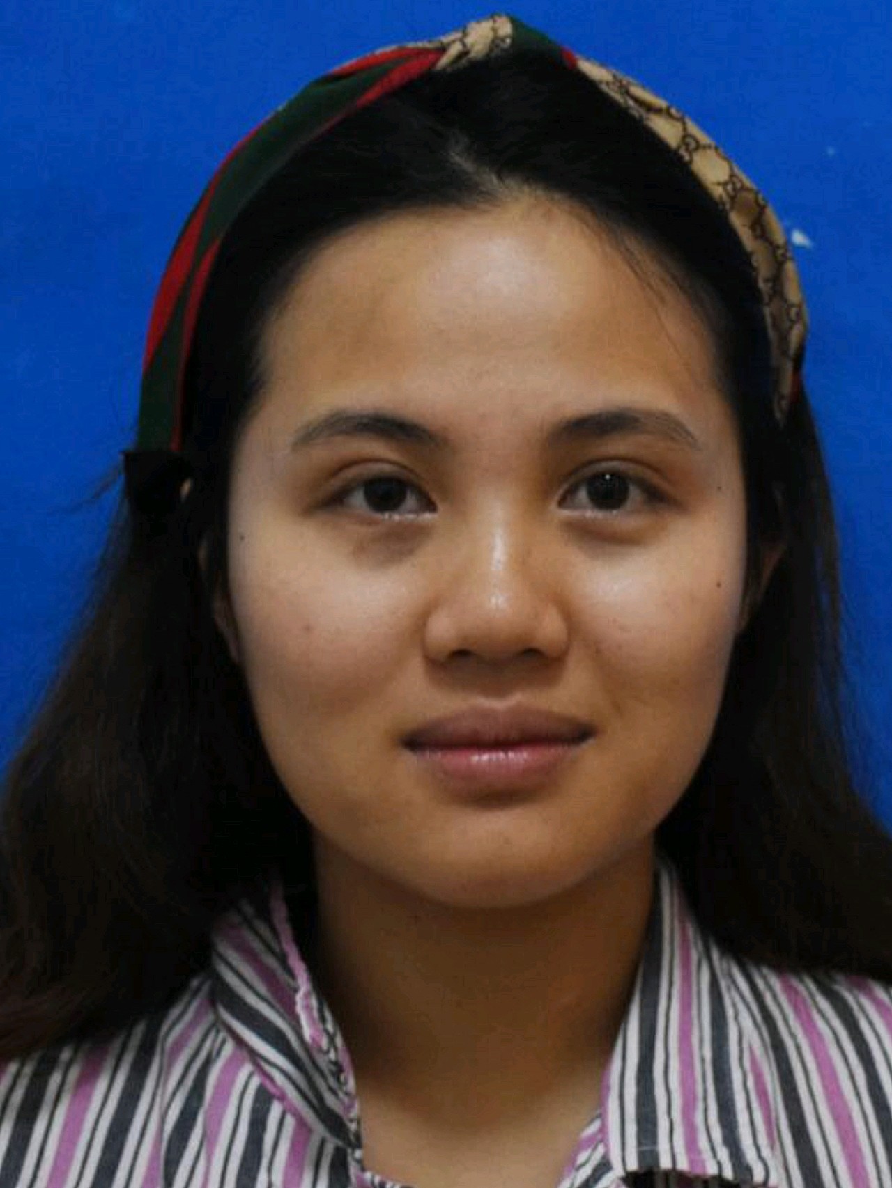 我鼻子是属于典型的大蒜鼻,鼻头特别大,基本第一眼看_圈子-新氧美容