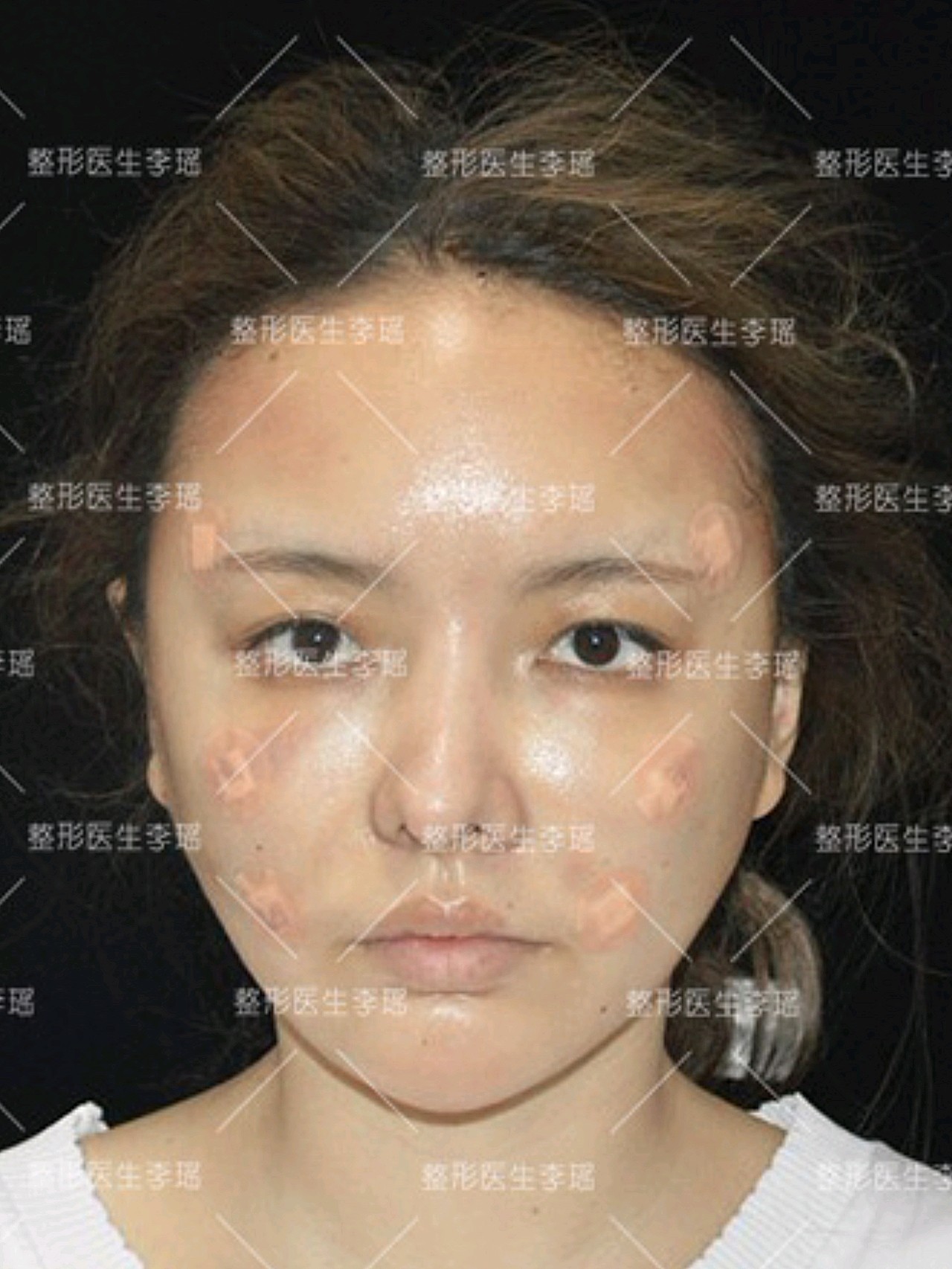 这位来自湖南怀化的顾客,术前额部,颞部凹陷比较明显_圈子-新氧美容