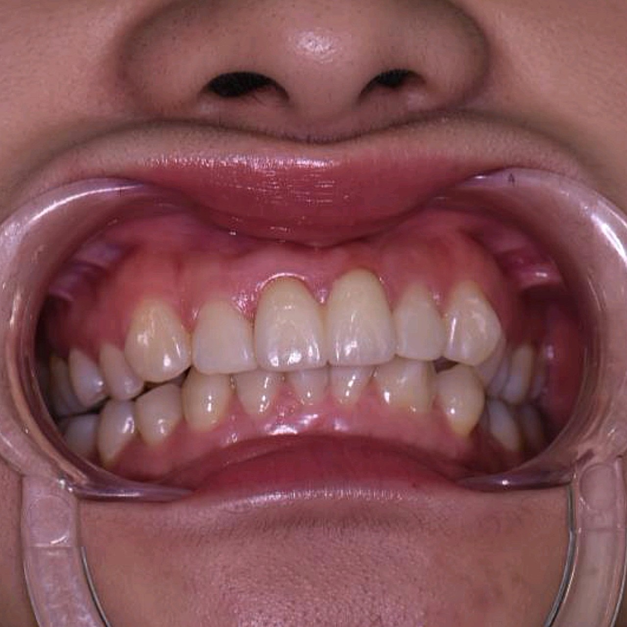 我小的时候因为虫牙,牙齿发炎的问题把4颗门牙换成了烤瓷牙,时间久