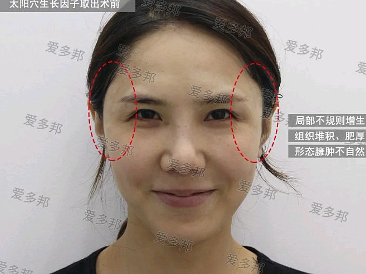 太阳穴生长因子取出术后反馈