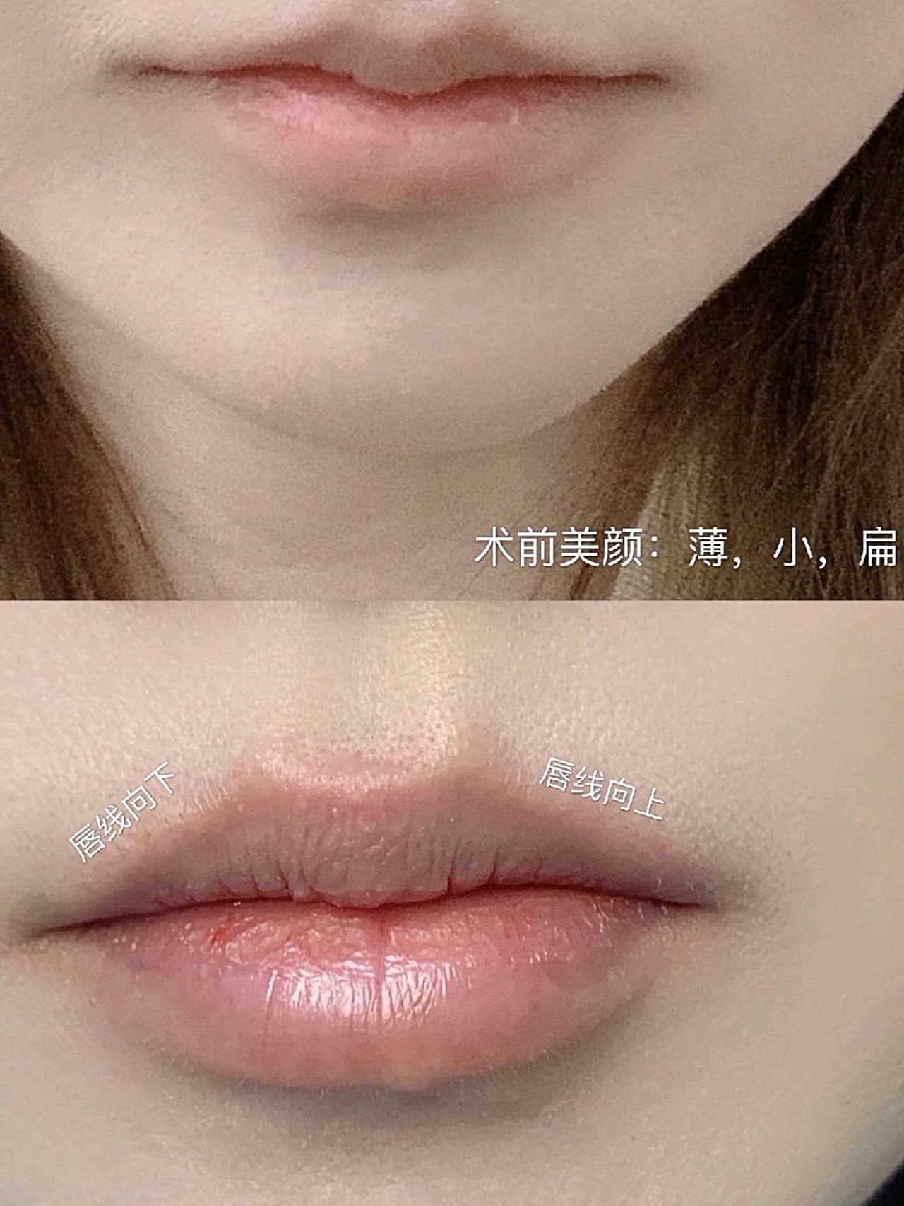 原来的唇形也不好看,不对称,而且也不饱满,怎么看怎_圈子-新氧美容