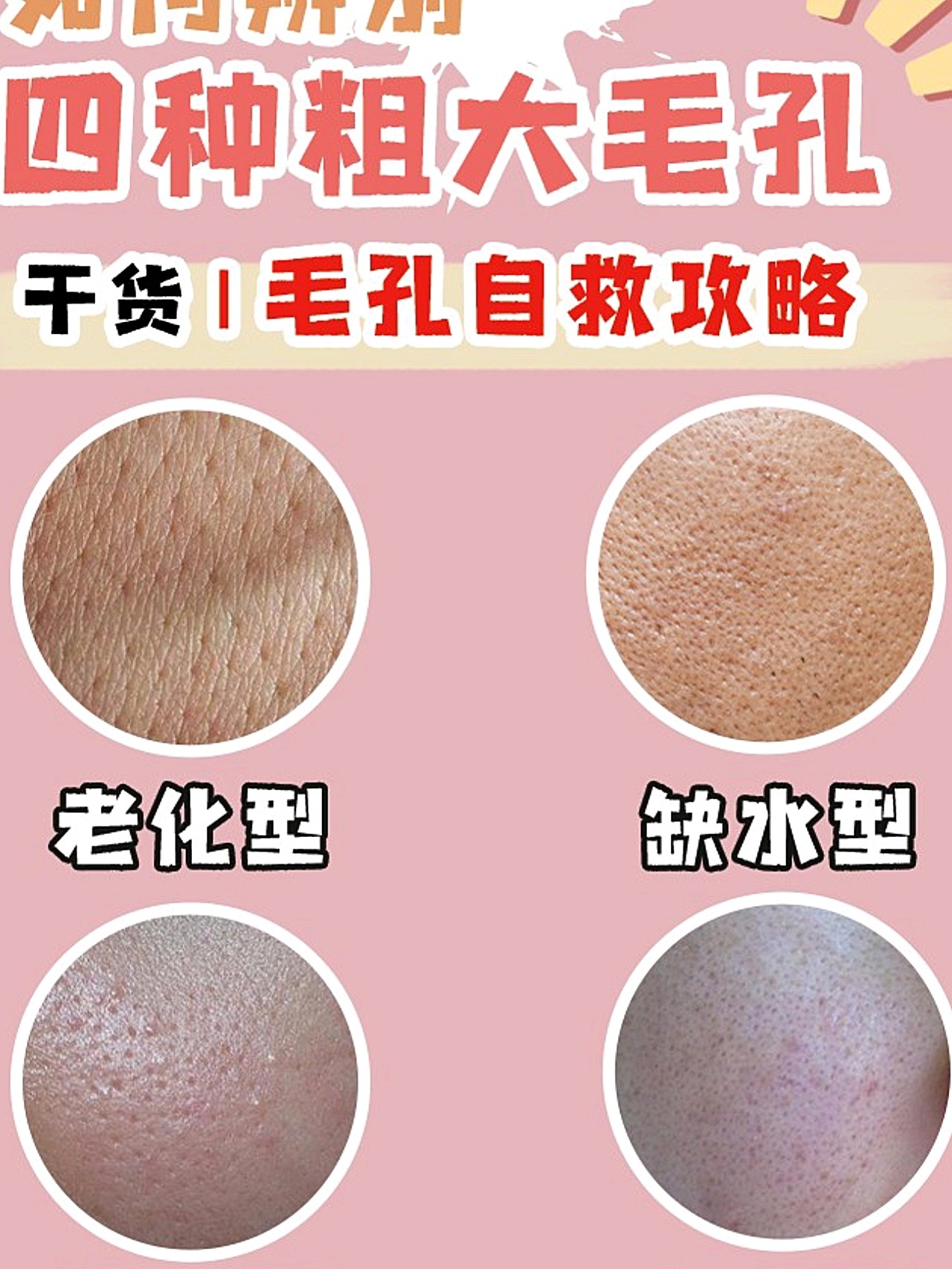 毛孔粗大自救攻略