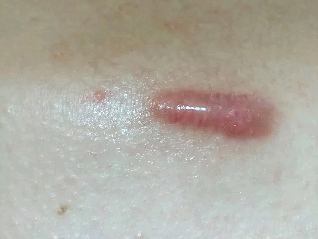 第108天疤痕体质真的有点惨,之前因为没有怎么在意_圈子-新氧美容整形