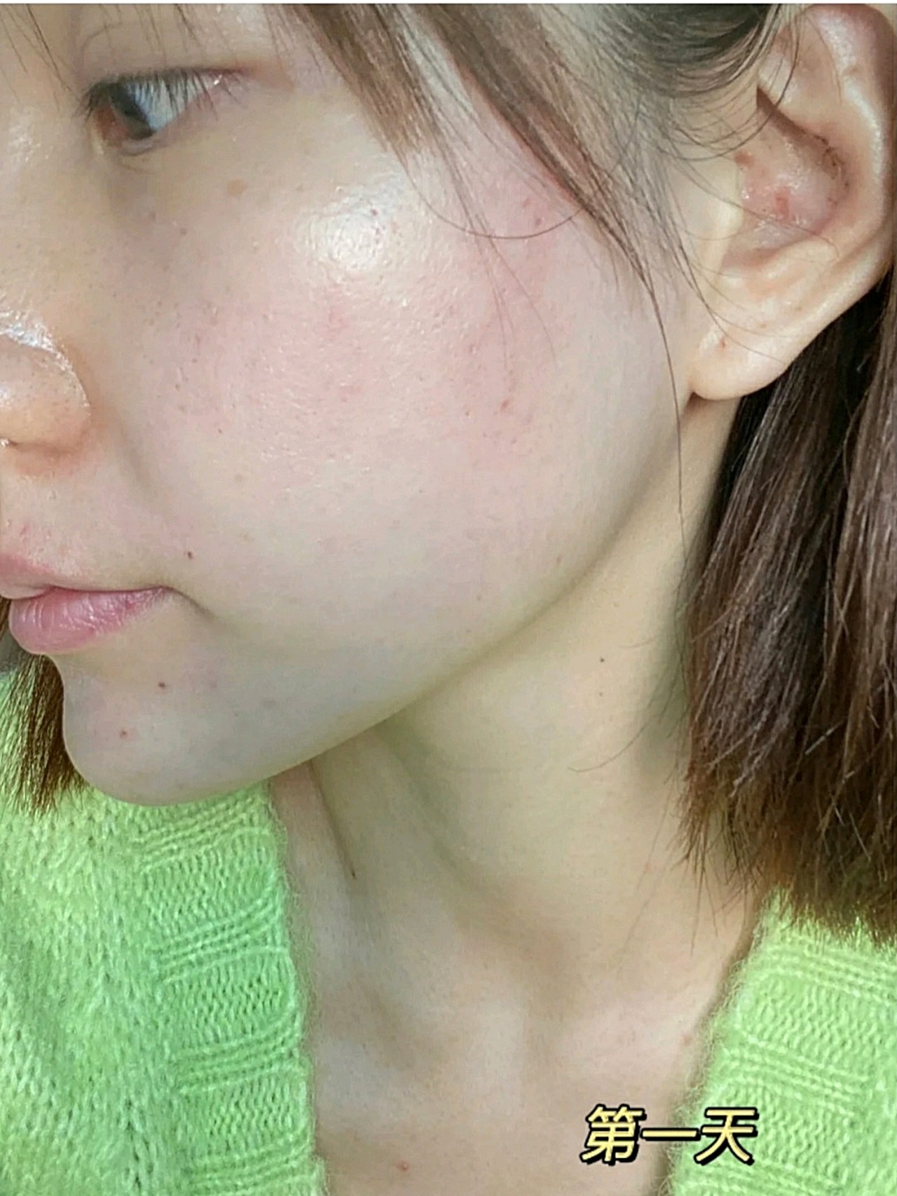 光子嫩肤对比,绝对美白.