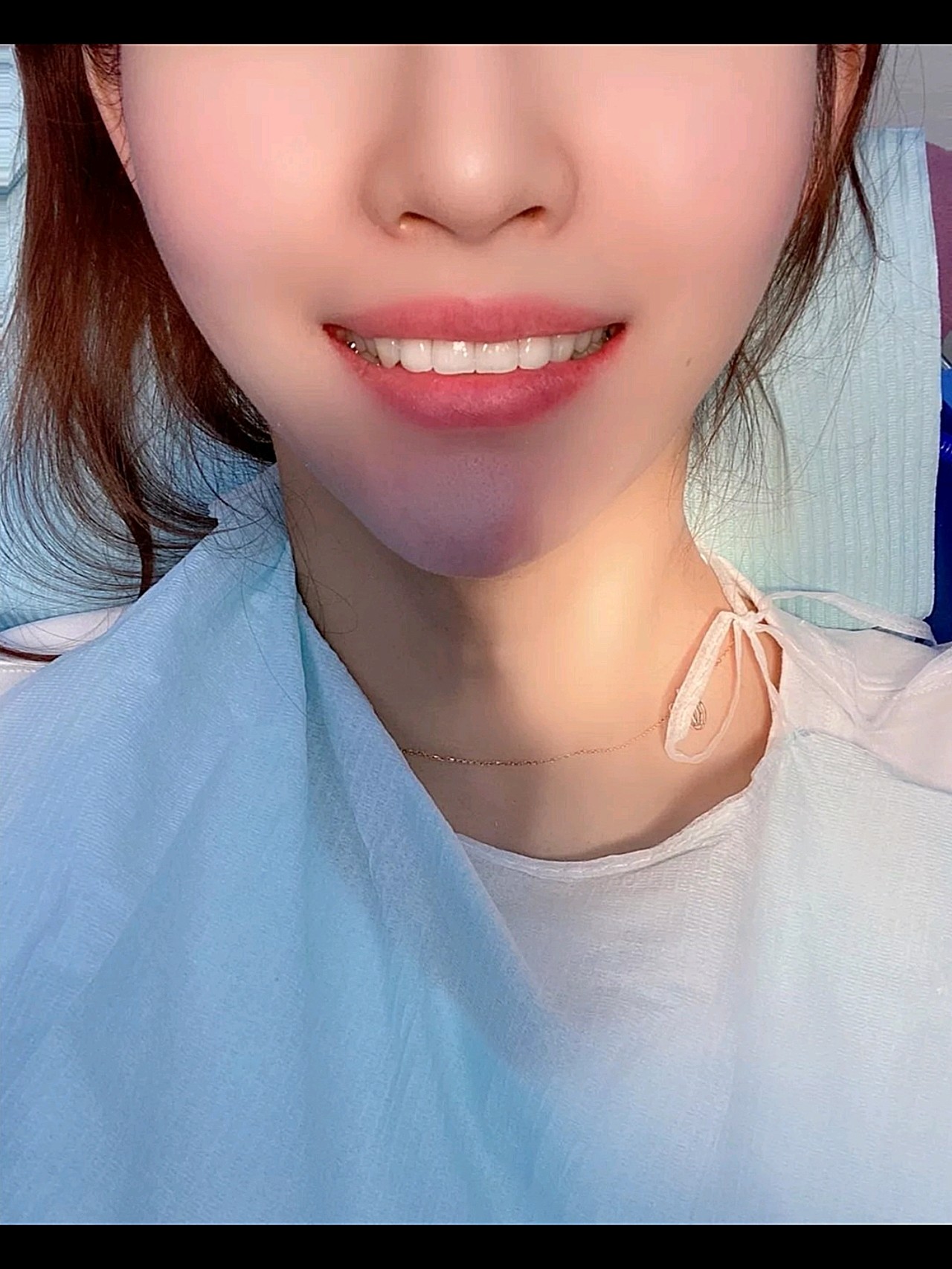 自从在企杏口腔门诊部医院补了牙齿之后,发现自己变得_圈子-新氧美容