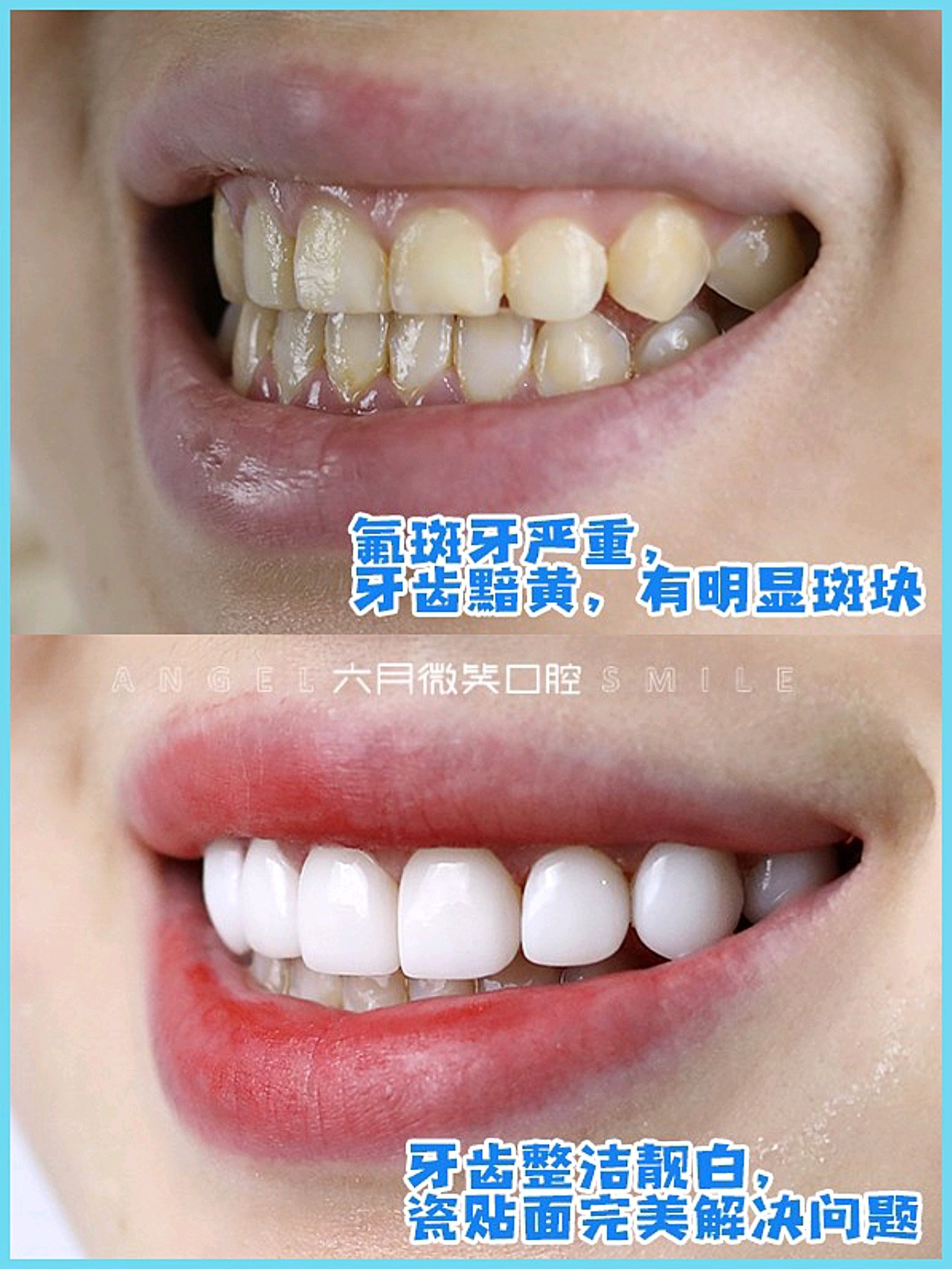 很多氟斑牙患者都会尝试很多牙齿美白方式,比如:99美_圈子-新氧美容