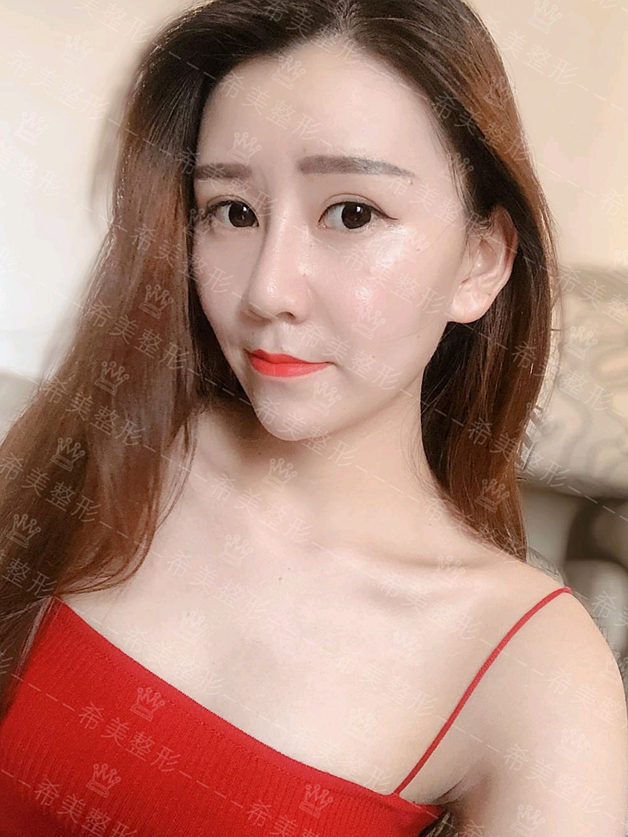 我这次的埋线提升做得很成功,脸部轮廓清晰,采用的是_圈子-新氧美容