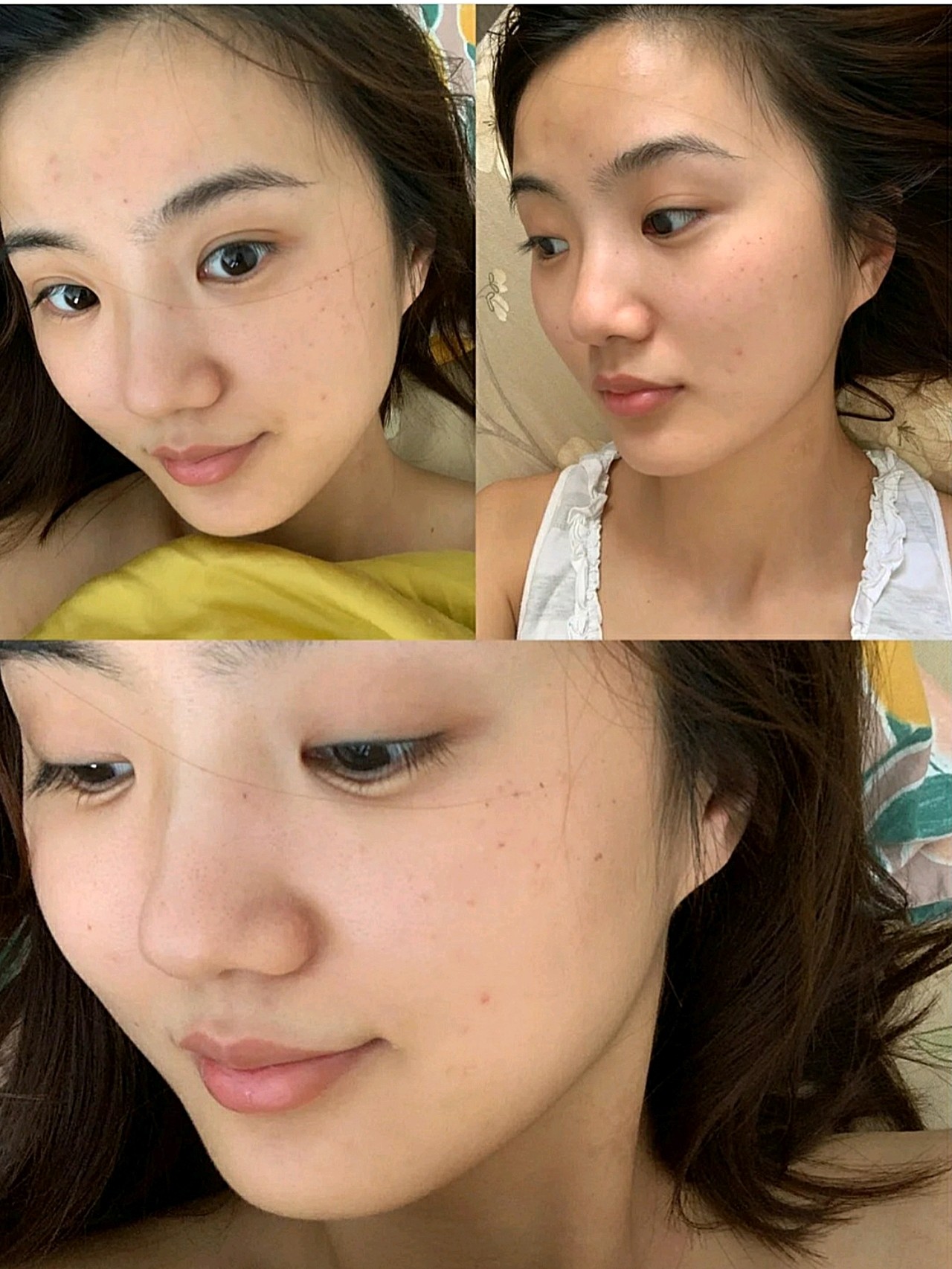 医美小白初体验m22第七代超光子光子嫩肤从来没接触过医美的我这次