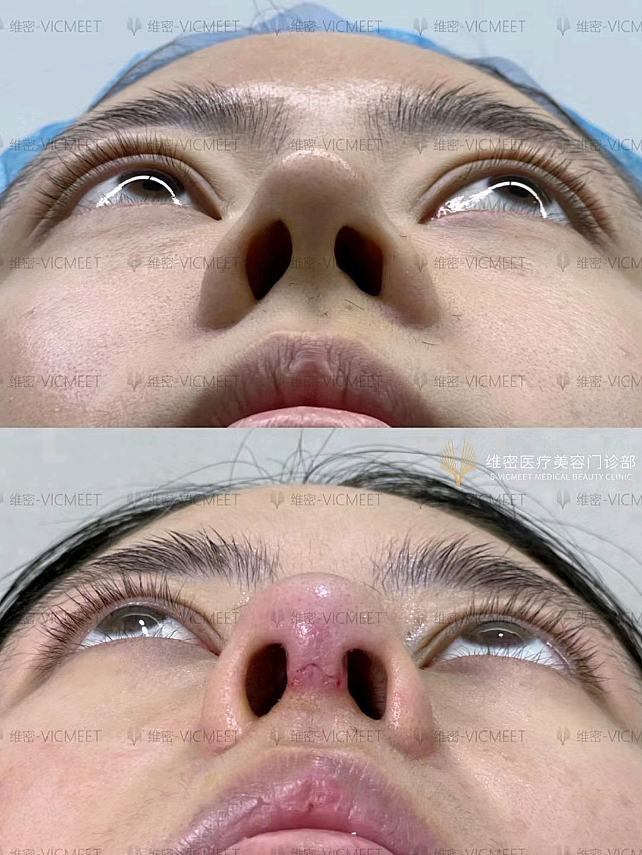 自体肋软骨修复术后10天拆线,术前假体山根起点太高,棍感明显假体显形