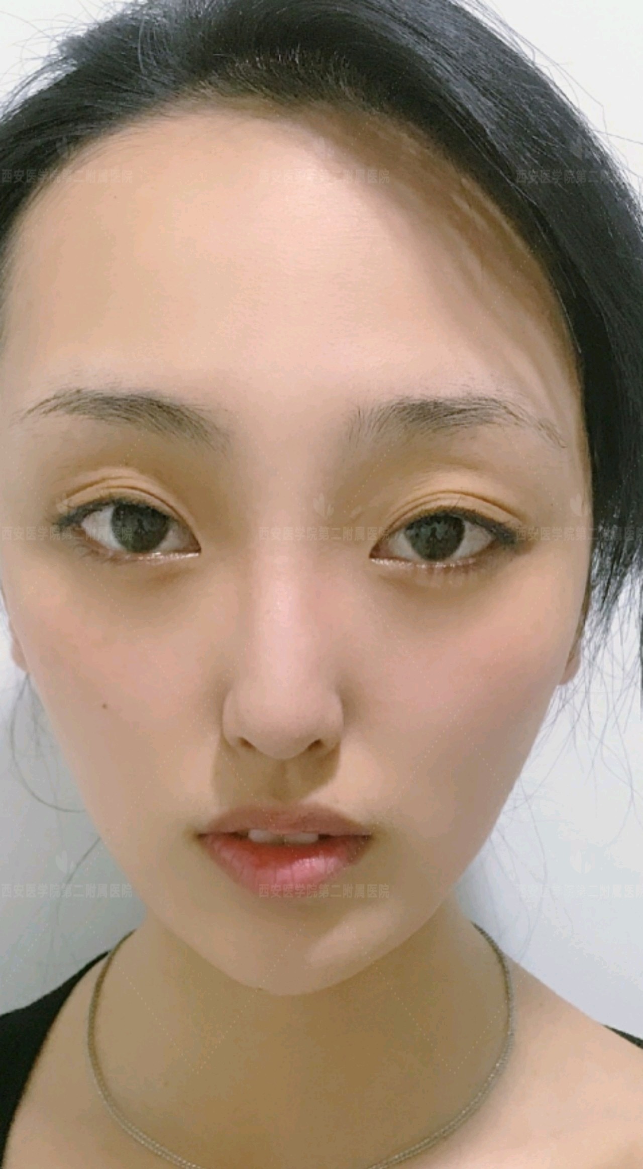 【术前诊断】:术前双侧眼睛呈多层眼皮,上睑松弛下垂_圈子-新氧美容