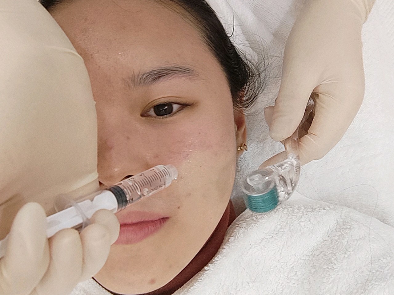 赛洛斯汀逆龄胶原微针体验官