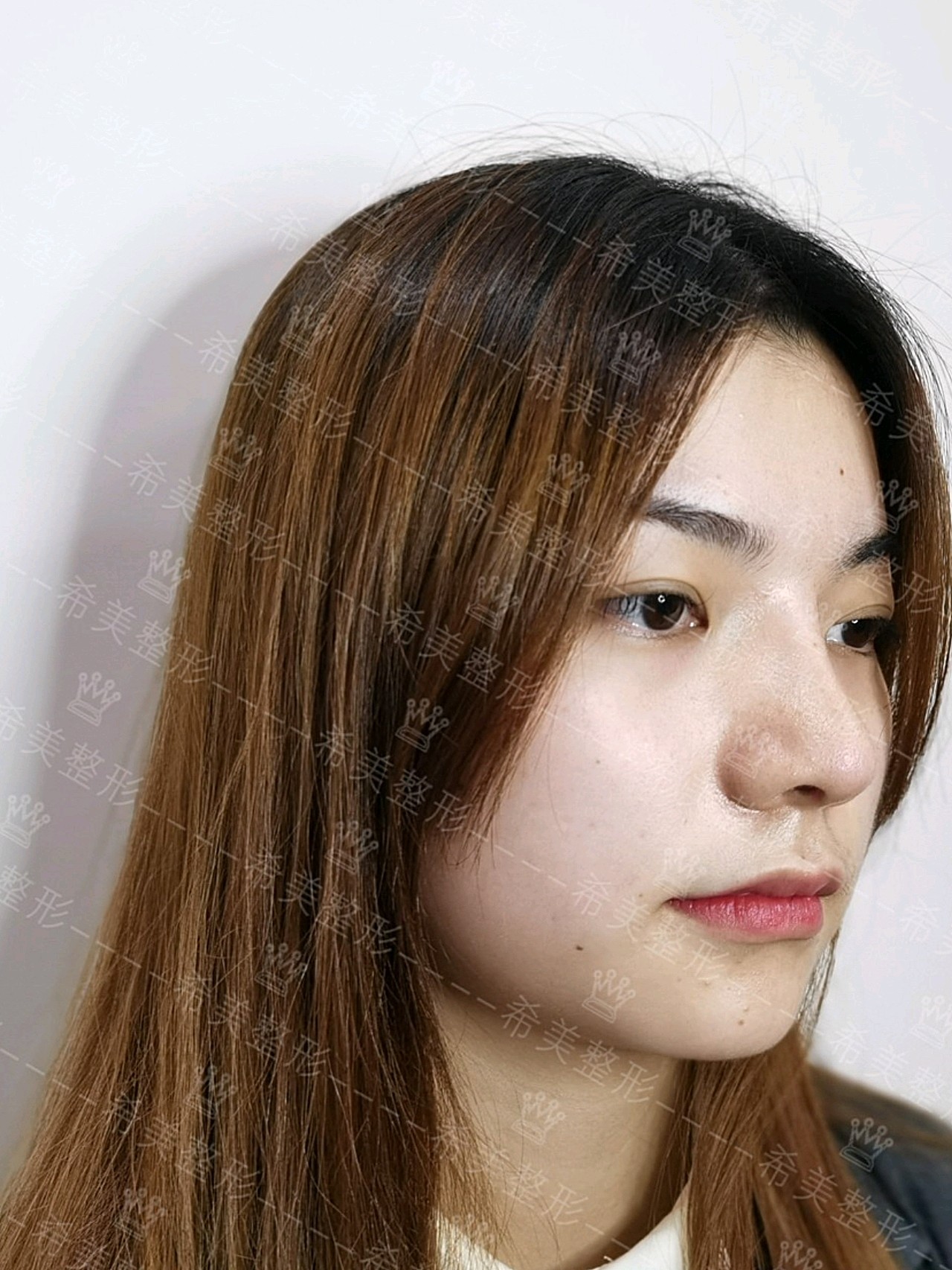 到拆线后的自己,鼻梁高了,还很挺翘,显的五官立体,_圈子-新氧美容整形