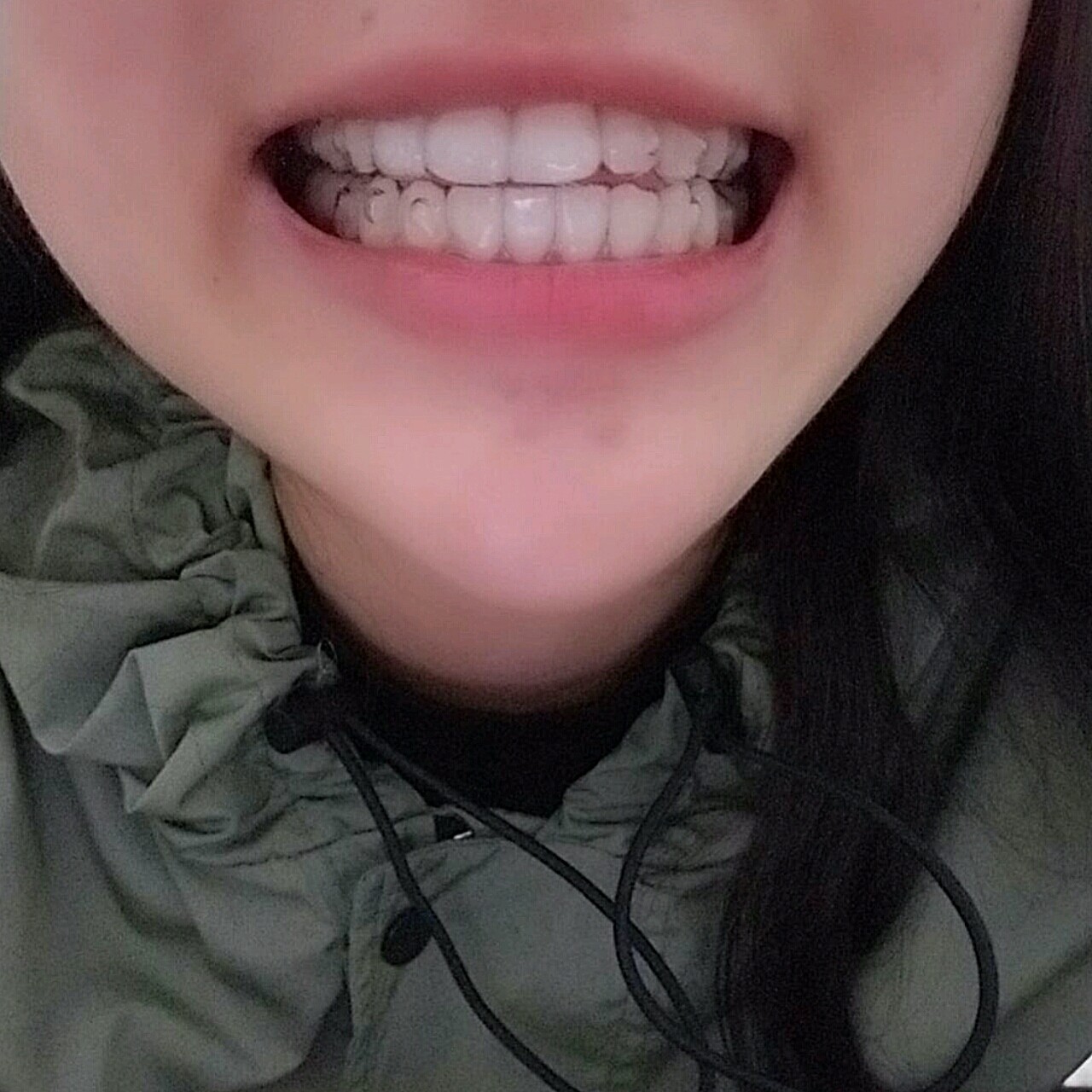 戴牙套已经是半年的时间了