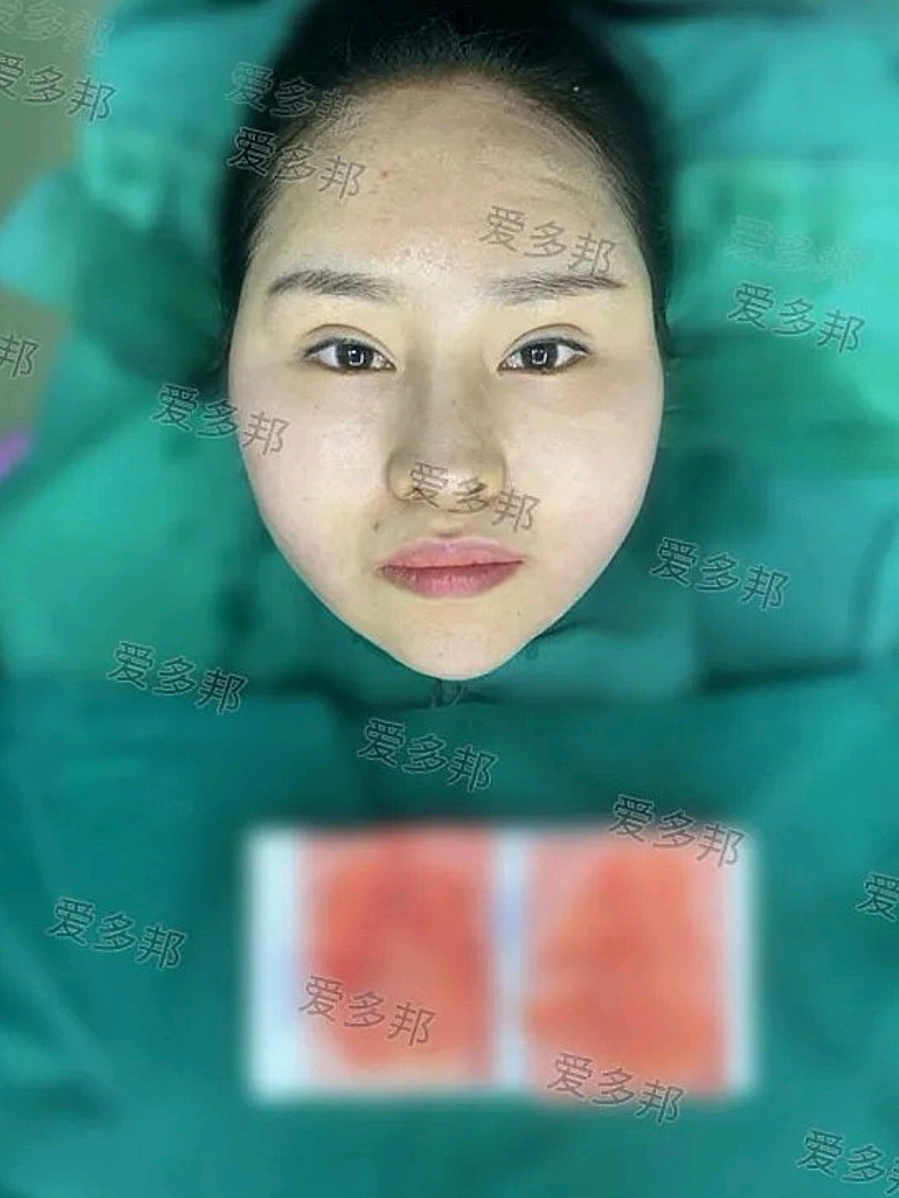 面颊生长因子取出2个月反馈!2013年注射的生长因_圈子-新氧美容整形