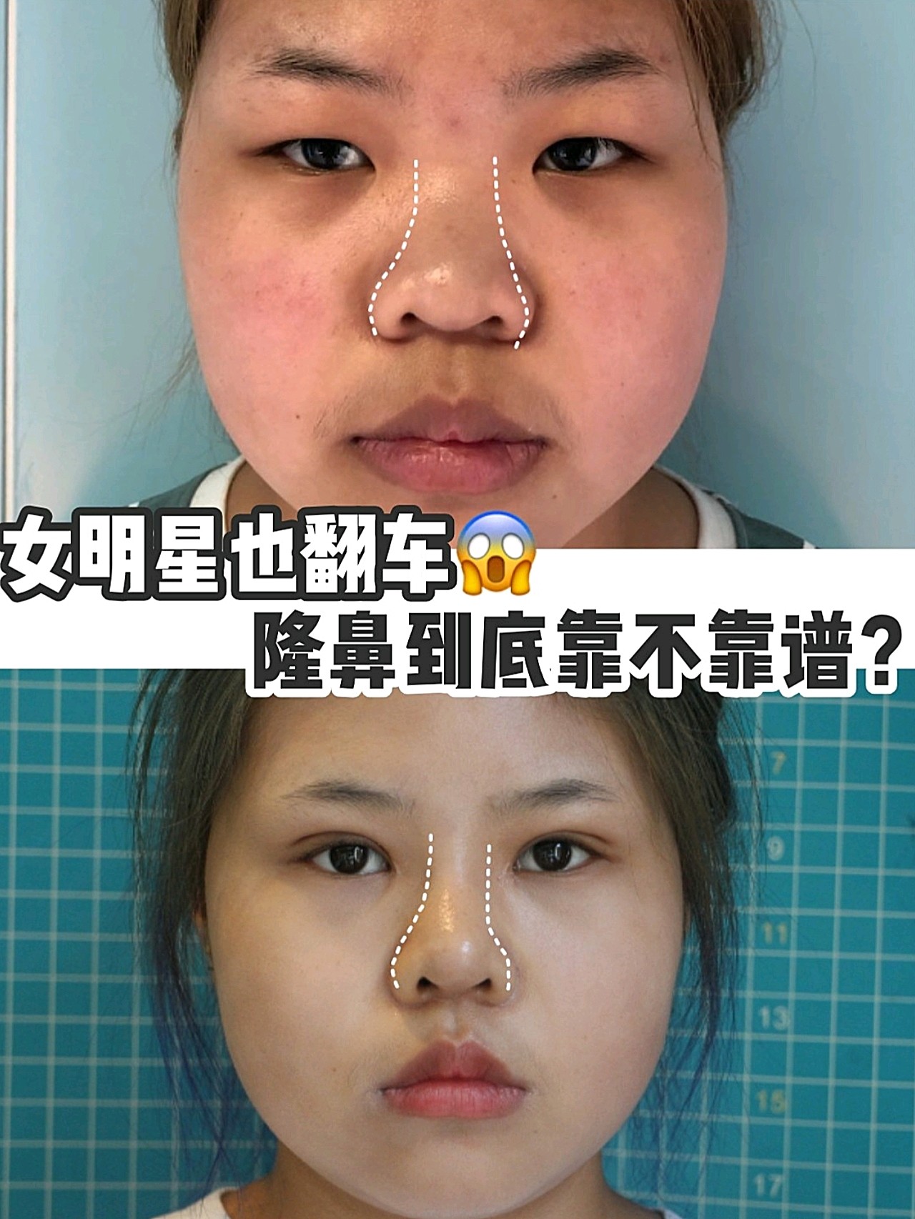 bestpictg5n7 鼻整形失敗1650 鼻整形失敗修正