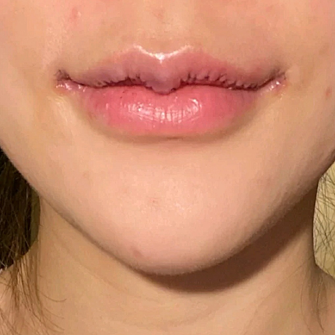 这是我m唇改善后即刻效果唇形不好看主要是比例和上下_圈子-新氧美容